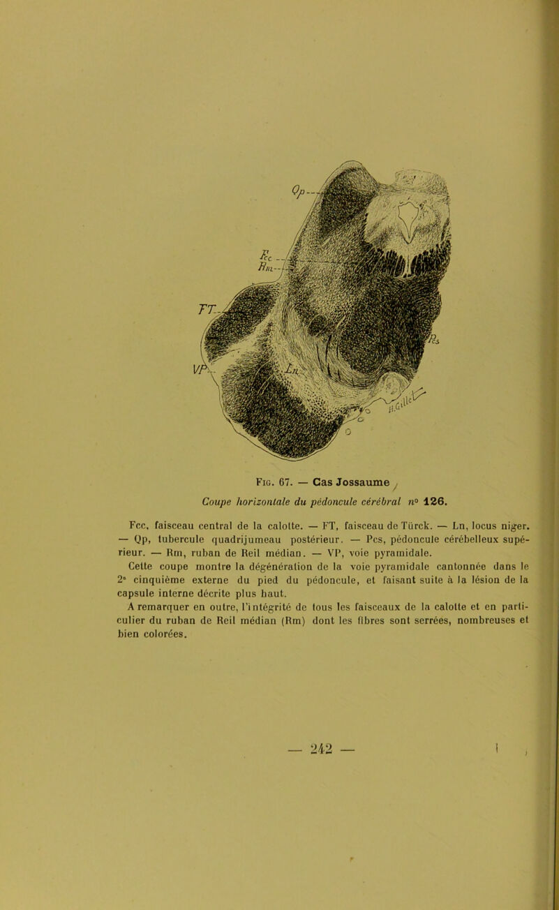 Coupe horizontale du pédoncule cérébral n° 126. Fcc, faisceau central de la calotte. — FT, faisceau de Türck. — Ln, locus niger. — Qp, tubercule quadrijumeau postérieur. — Pcs, pédoncule cérébelleux supé- rieur. — Rm, ruban de Reil médian. — VP, voie pyramidale. Cette coupe montre la dégénération de la voie pyramidale cantonnée dans le 2° cinquième externe du pied du pédoncule, et faisant suite à la lésion de la capsule interne décrite plus haut. A remarquer en outre, l’intégrité de tous les faisceaux de la calotte et en parti- culier du ruban de Reil médian (Rm) dont les fibres sont serrées, nombreuses et bien colorées.