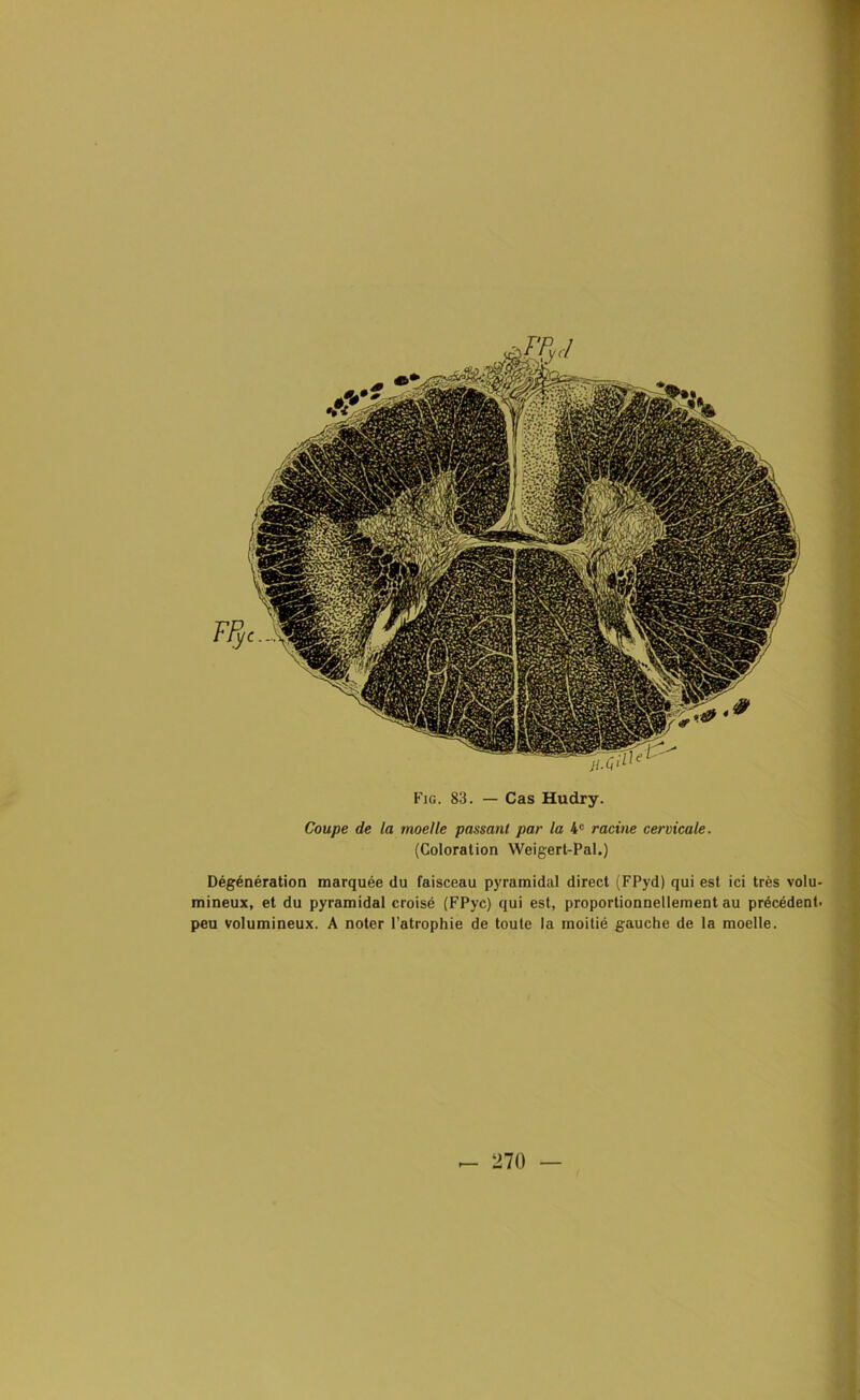 Coupe de la moelle passant par la 4e racine cervicale. (Coloration Weigert-Pal.) Dégénération marquée du faisceau pyramidal direct (FPyd) qui est ici très volu- mineux, et du pyramidal croisé (FPyc) qui est, proportionnellement au précédent, peu volumineux. A noter l’atrophie de toute la moitié gauche de la moelle.