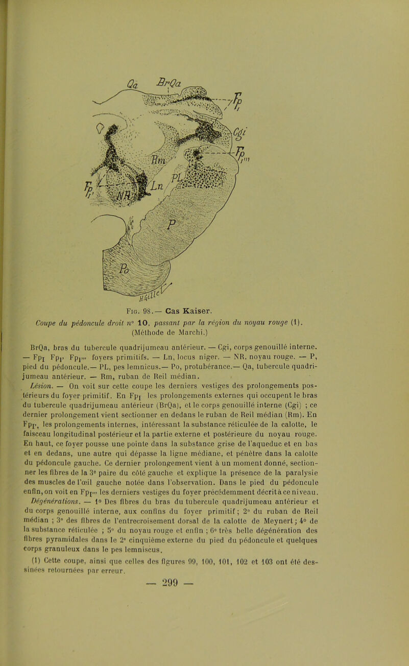 Coupe du pédoncule droit n° 10, passant par la répion du noyau rouge (1). (Méthode de Marchi.) BrQa, bras du tubercule quadrijumeau antérieur. — Cgi, corps genouillé interne. — Fpj Fp|. Fpj... foyers primitifs. — Ln, locus niger. — NR, noyau rouge. — P, pied du pédoncule.— PL, pes lemnicus.— Po, protubérance.— Qa, tubercule quadri- jumeau antérieur. — Rm, ruban de Reil médian. Lésion. — On voit sur cette coupe les derniers vestiges des prolongements pos- térieurs du foyer primitif. En Fpj les prolongements externes qui occupent le bras du tubercule quadrijumeau antérieur (BrQa), et le corps genouillé interne (Cgi) ; ce dernier prolongement vient sectionner en dedans le ruban de Reil médian (Rm). En Fpj., les prolongements internes, intéressant la substance réticulée de la calotte, le faisceau longitudinal postérieur et la partie externe et postérieure du noyau rouge. En haut, ce foyer pousse une pointe dans la substance grise de l’aqueduc et en bas et en dedans, une autre qui dépasse la ligne médiane, et pénètre dans la calotte du pédoncule gauche. Ce dernier prolongement vient à un moment donné, section- ner les fibres de la 3e paire du côté gauche et explique la présence de la paralysie des muscles de l’œil gaucho notée dans l’observation. Dans le pied du pédoncule enfin,on voit en Fpj.» les derniers vestiges du foyer précédemment décritàce niveau. Dégénéralions. — 1° Des fibres du bras du tubercule quadrijumeau antérieur et du corps genouillé interne, aux confins du foyer primitif; 2 du ruban de Reil médian ; 3° des fibres de l’entrecroisement dorsal de la calotte de Meynert ; 4° de la substance réticulée ; 5° du noyau rouge et enfin ; G0 très belle dégénération des fibres pyramidales dans le 2” cinquième externe du pied du pédoncule et quelques corps granuleux dans le pes lemniscus. (1) Cette coupe, ainsi que celles des figures 99, 100, 101, 102 et 103 ont été des- sinées retournées par erreur.