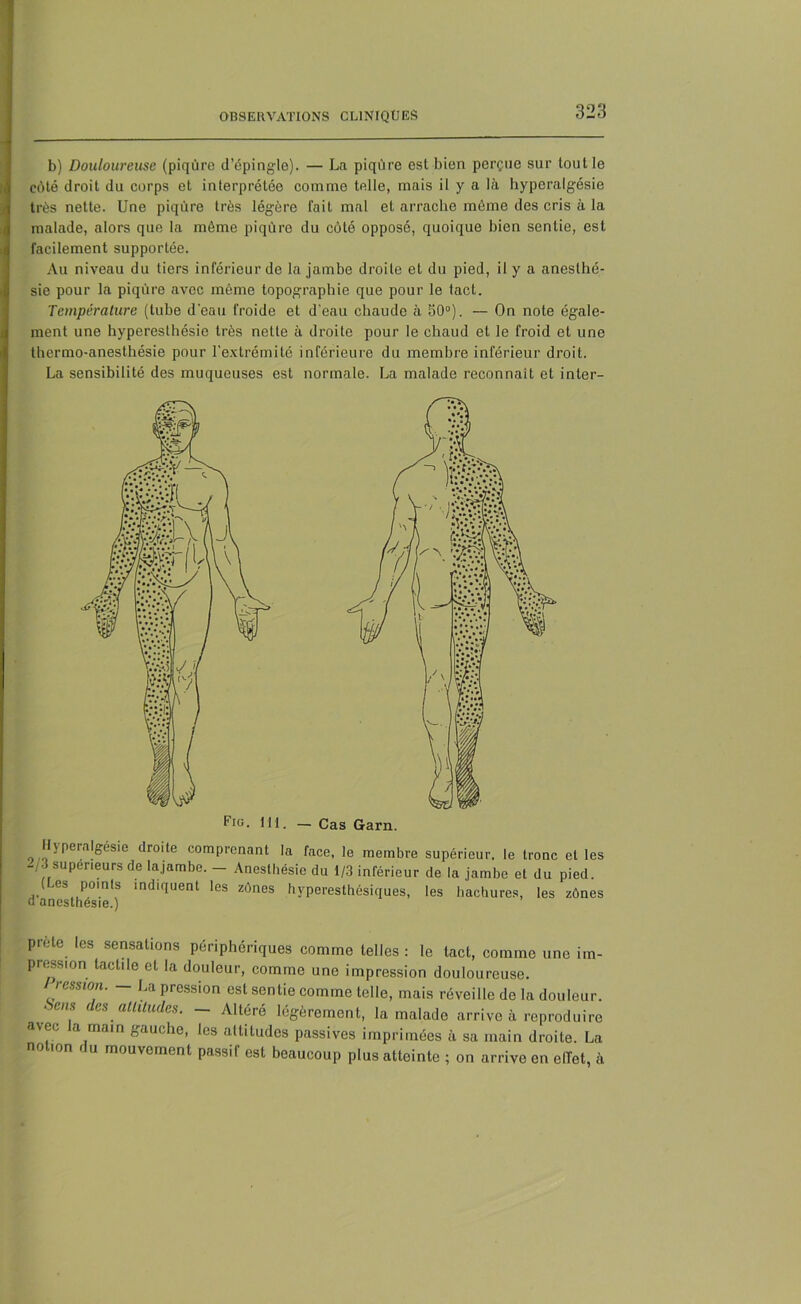 b) Douloureuse (piqûre d’épingle). — La piqûre est bien perçue sur tout le coté droit du corps et interprétée comme telle, mais il y a là hyperalgésie très nette. Une piqûre très légère fait mal et arrache même des cris à la malade, alors que la môme piqûre du côté opposé, quoique bien sentie, est facilement supportée. Au niveau du tiers inférieur de la jambe droite et du pied, il y a anesthé- sie pour la piqûre avec même topographie que pour le tact. Température (tube d'eau froide et d'eau chaude à 50°). — On note égale- ment une hyperesthésie très nette à droite pour le chaud et le froid et une thermo-anesthésie pour l’extrémité inférieure du membre inférieur droit. La sensibilité des muqueuses est normale. La malade reconnaît et inter- Hyperalgésie droite comprenant la face, le membre supérieur, le tronc et les -/J supérieurs de lajambe. - Anesthésie du 1/3 inférieur de la jambe et du pied. (Les points indiquent les zônes hyperesthésiques, les hachures, les zônes d anesthésie.) prête les sensations périphériques comme telles : le tact, comme une im- pression lacLile et la douleur, comme une impression douloureuse. ression. — La pression est sentie comme telle, mais réveille de la douleur. ■ eus (les altitudes. — Altéré légèrement, la malade arrive à reproduire avec a main gauche, les altitudes passives imprimées à sa main droite. La notmn du mouvement passif est beaucoup plus atteinte ; on arrive en effet, à