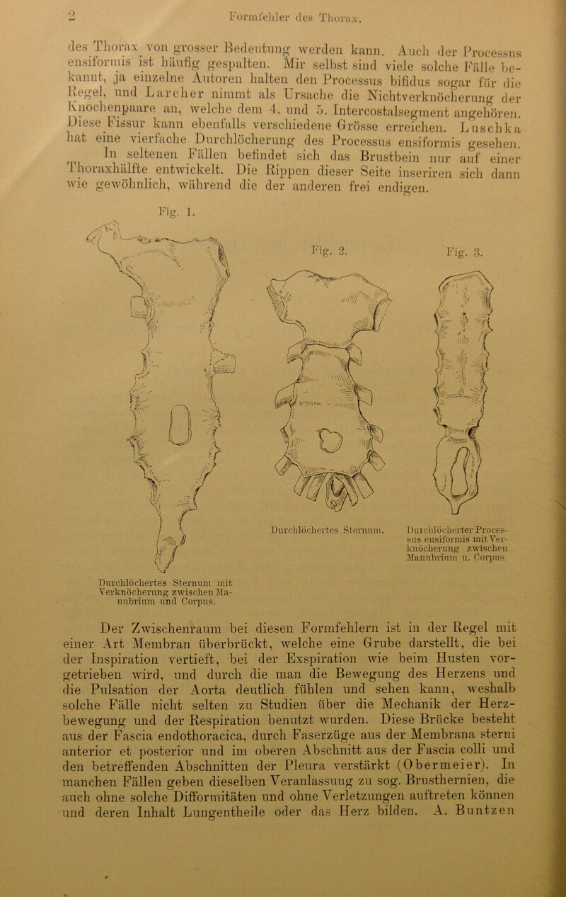 des Thorax von grosser Bedeutung werden kann. . . - ^ — Auch der Processus ensitormis ist häufig gespalten. Mir selbst sind viele solche Fälle be- kannt, ja einzelne Autoren halten den Processus bifidus sogar für die Pegel, und Larcher nimmt als Ursache die Nichtverknöcherung der Ivnochenpaaie an, welche dem 4. und 5. Intercostalsegment angehören. Diese Fissur kann ebenfalls verschiedene Grösse erreichen. Luschka hat eine vierfache Durchlöcherung des Processus ensiformis gesehen. ^ lu seltenen F allen befindet sich das Brustbein nur auf einer 1 hoi axhcilfte entwickelt. Die Rippen dieser Seite mseriren sich dann wie gewöhnlich, während die der anderen frei endigen O * Fig. 1. Durchlöchertes Sternum mit Verknöcherung zwischen Ma- nubrium und Corpus. Fig. 3. Durchlöcherter Proces- sus ensiformis mit Ver- knöcherung zwischen Mannbrium u. Corpus. Der Zwischenraum bei diesen Formfehlern ist in der Regel mit einer Art Membran iiberbrückt, welche eine Grube darstellt, die bei der Inspiration vertieft, bei der Exspiration wie beim Husten vor- getrieben wird, und durch die man die Bewegung des Herzens und die Pulsation der Aorta deutlich fühlen und sehen kann, weshalb solche Fälle nicht selten zu Studien über die Mechanik der Herz- bewegung und der Respiration benutzt wurden. Diese Brücke besteht aus der Fascia endothoracica, durch Faserzüge aus der Membrana sterni anterior et posterior und im oberen Abschnitt aus der Fascia colli und den betreffenden Abschnitten der Pleura verstärkt (Obermeier). In manchen Fällen geben dieselben Veranlassung zu sog. Brusthernien, die auch ohne solche Difformitäten und ohne Verletzungen auftreten können und deren Inhalt Lungentheile oder das Herz bilden. A. Buntzen