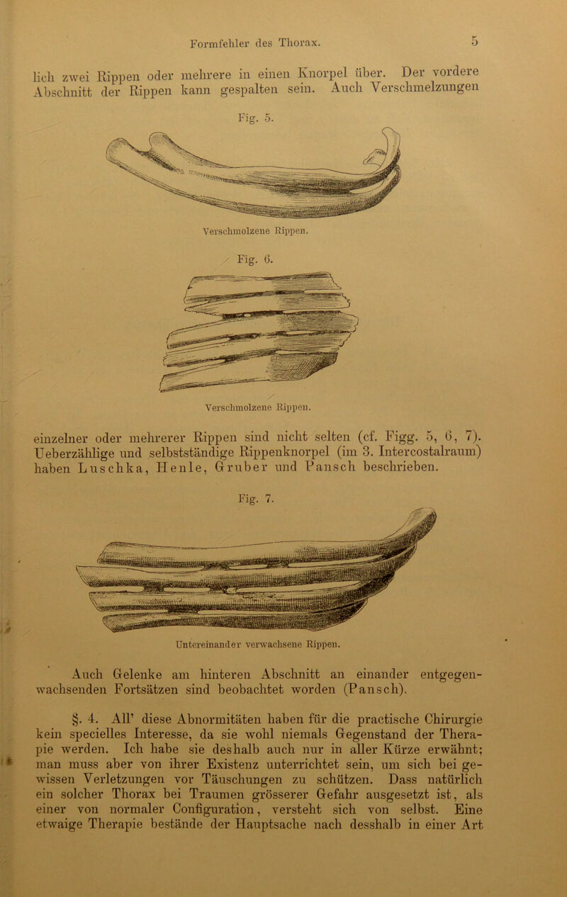 lieh zwei Rippen oder mehrere in einen Knorpel über. Der vordere Abschnitt der Rippen kann gespalten sein. Auch Verschmelzungen Fig. 5. Verschmolzene Rippen. Fig. 6. einzelner oder mehrerer Rippen sind nicht selten (cf. Figg. 5, 6, 7). Ueberzählige und selbstständige Rippenknorpel (im 3. Intercostalraum) haben Luschka, Heule, Grub er und Pansch beschrieben. Untereinander verwachsene Rippen. Auch Gelenke am hinteren Abschnitt an einander entgegen- wachsenden Fortsätzen sind beobachtet worden (Pansch). §. 4. All1 diese Abnormitäten haben für die practische Chirurgie kein specielles Interesse, da sie wohl niemals Gegenstand der Thera- pie werden. Ich habe sie deshalb auch nur in aller Kürze erwähnt; man muss aber von ihrer Existenz unterrichtet sein, um sich bei ge- wissen Verletzungen vor Täuschungen zu schützen. Dass natürlich ein solcher Thorax bei Traumen grösserer Gefahr ausgesetzt ist, als einer von normaler Configuration, versteht sich von selbst. Eine etwaige Therapie bestände der Hauptsache nach desshalb in einer Art