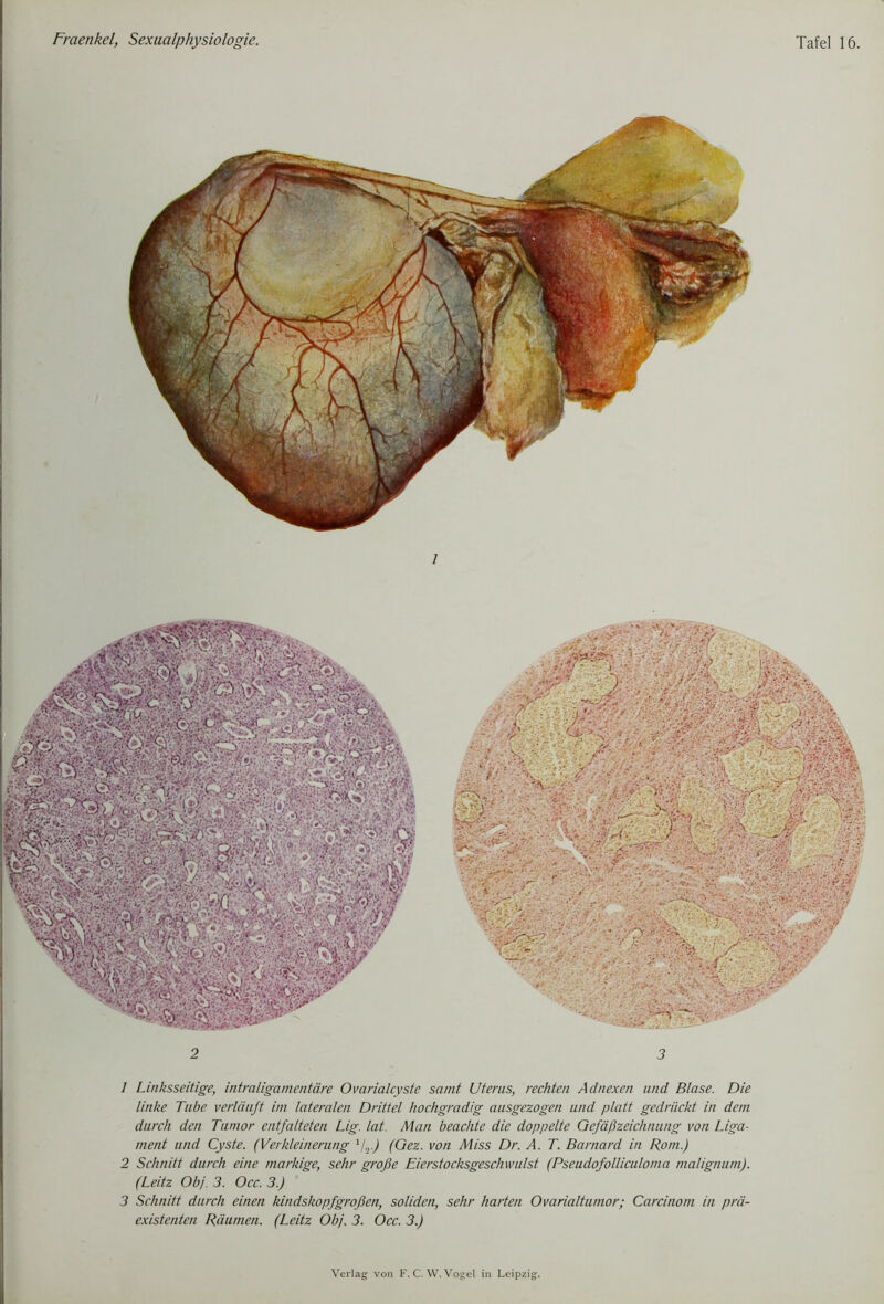 1 Linksseitige, intraligamentäre Ovarialcyste samt Uterus, rechten Adnexen und Blase. Die linke Tube verläuft im lateralen Drittel hochgradig ausgezogen und platt gedrückt in dem durch den Tumor entfalteten Lig. lat. Man beachte die doppelte Gefäßzeichnung von Liga- ment und Cyste. (Verkleinerung 1/t.) (Gez. von Miss Dr. A. T. Barnard in Rom.) 2 Schnitt durch eine markige, sehr große Eierstocksgeschwulst (Pseudofolliculoma malignum). (Leitz Obj. 3. Occ. 3.) 3 Schnitt durch einen kindskopfgroßen, soliden, sehr harten Ovarialtumor; Carcinom in prä- existenten Räumen. (Leitz Obj. 3. Occ. 3.)
