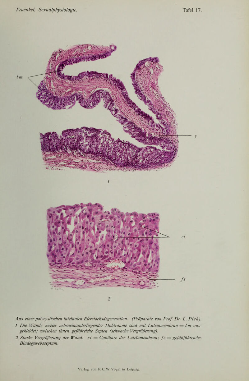 Aus einer polycystischen luteinalen Eierstocksdegeneration. (Präparate von Prof. Dr. L. Pick). 1 Die Wände zweier nebeneinanderliegender Hohlräume sind mit Lateinmembran = Im aus- gekleidet; zwischen ihnen gefäßreiche Septett (schwache Vergrößerung). 2 Starke Vergrößerung der Wand, cl = Capillare der Luteinmembran; fs = gefäßführendes Bindegewebsseptum.