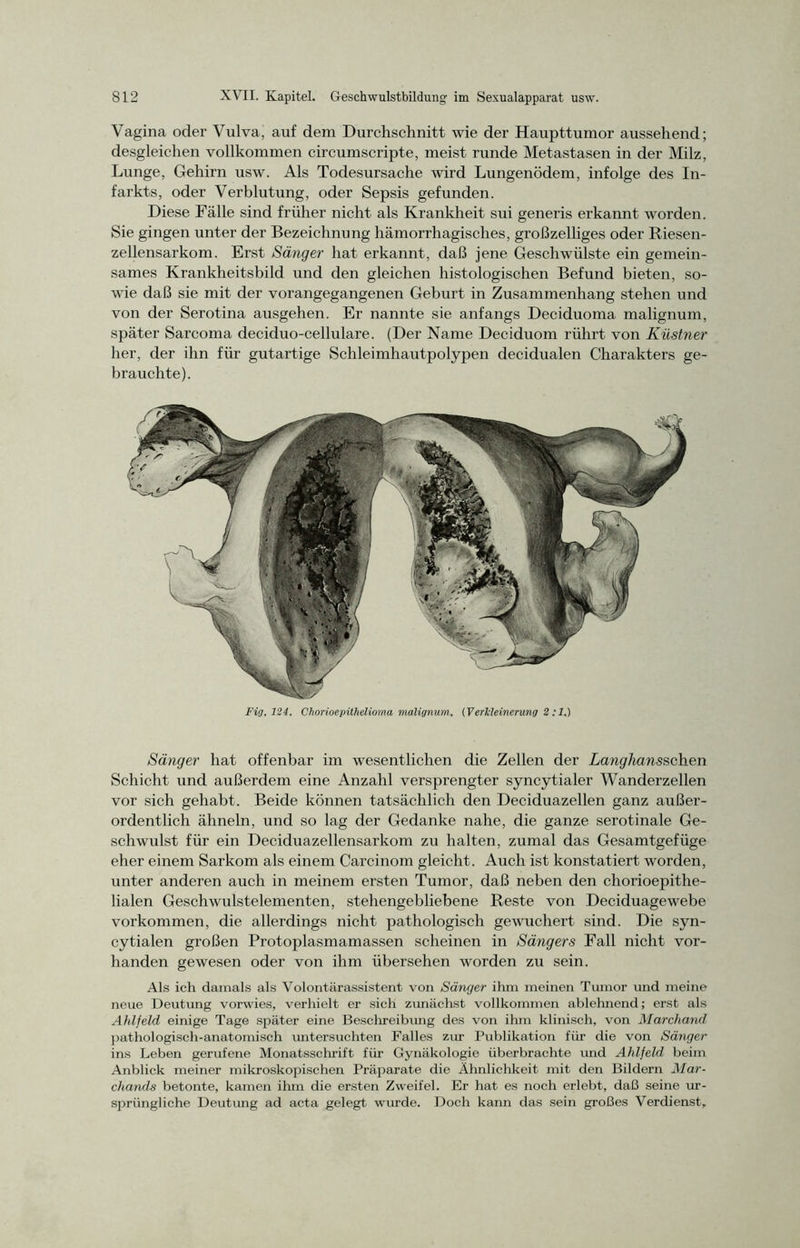 Vagina oder Vulva, auf dem Durchschnitt wie der Haupttumor aussehend; desgleichen vollkommen circumscripte, meist runde Metastasen in der Milz, Lunge, Gehirn usw. Als Todesursache wird Lungenödem, infolge des In- farkts, oder Verblutung, oder Sepsis gefunden. Diese Fälle sind früher nicht als Krankheit sui generis erkannt worden. Sie gingen unter der Bezeichnung hämorrhagisches, großzelliges oder Riesen- zellensarkom. Erst Sänger hat erkannt, daß jene Geschwülste ein gemein- sames Krankheitsbild und den gleichen histologischen Befund bieten, so- wie daß sie mit der vorangegangenen Geburt in Zusammenhang stehen und von der Serotina ausgehen. Er nannte sie anfangs Deciduoma malignum, später Sarcoma deciduo-cellulare. (Der Name Deciduom rührt von Küstner her, der ihn für gutartige Schleimhautpolypen decidualen Charakters ge- brauchte). Fi(j. 124. Chorioepithelioma malignum. (Verkleinerung 2:1.) Sänger hat offenbar im wesentlichen die Zellen der Langhansschen Schicht und außerdem eine Anzahl versprengter syncytialer Wanderzellen vor sich gehabt. Beide können tatsächlich den Deciduazellen ganz außer- ordentlich ähneln, und so lag der Gedanke nahe, die ganze serotinale Ge- schwulst für ein Deciduazellensarkom zu halten, zumal das Gesamtgefüge eher einem Sarkom als einem Carcinom gleicht. Auch ist konstatiert worden, unter anderen auch in meinem ersten Tumor, daß neben den chorioepithe- lialen Geschwulstelementen, stehengebliebene Reste von Deciduagewebe Vorkommen, die allerdings nicht pathologisch gewuchert sind. Die syn- cytialen großen Protoplasmamassen scheinen in Sängers Fall nicht vor- handen gewesen oder von ihm übersehen worden zu sein. Als ich damals als Volontärassistent von Sänger ihm meinen Tumor und meine neue Deutung vorwies, verhielt er sich zunächst vollkommen ablehnend; erst als Ahlfeld einige Tage später eine Beschreibung des von ihm klinisch, von Marcliand pathologisch-anatomisch untersuchten Falles zur Publikation für die von Sänger ins Leben gerufene Monatsschrift für Gynäkologie überbrachte und Ahlfeld beim Anblick meiner mikroskopischen Präparate die Ähnlichkeit mit den Bildern Mar- chands betonte, kamen ihm die ersten Zweifel. Er hat es noch erlebt, daß seine ur- sprüngliche Deutung ad acta gelegt wurde. Doch kann das sein großes Verdienst,