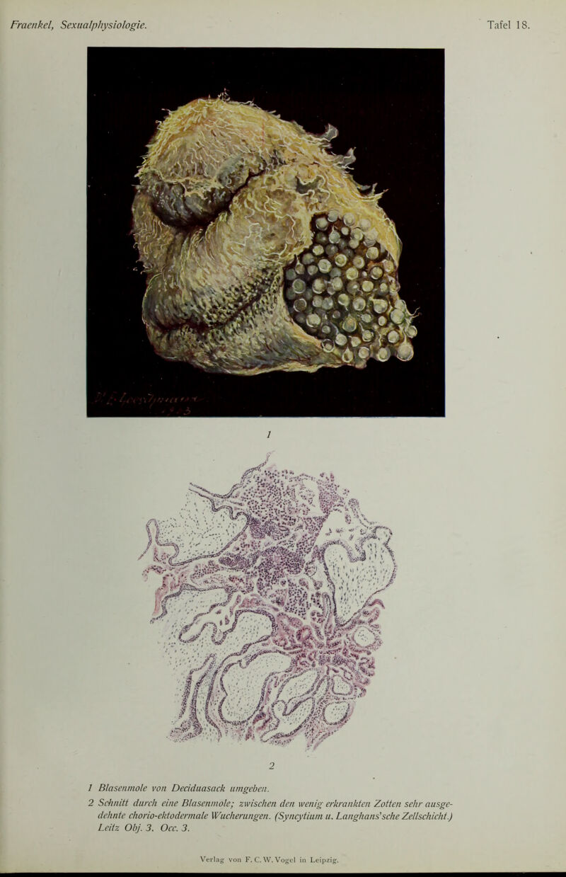 1 Blasenmole von Decidaasack umgeben. 2 Schnitt durch eine Blasenmole; zwischen den wenig erkrankten Zotten sehr ausge- dehnte chorio-ektodermale Wucherungen. (Syncytium u. Langhaus'sehe Zellschicht.) Leiiz Obj. 3. Occ. 3.