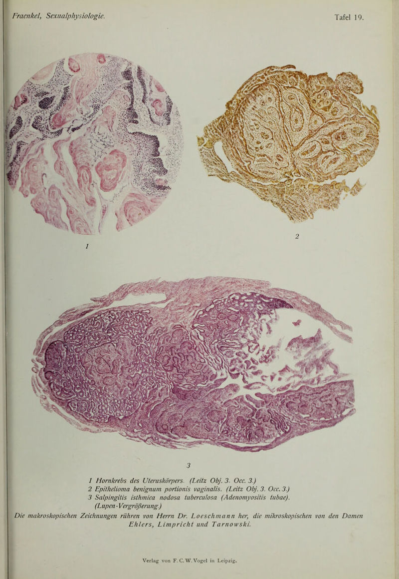 3 1 Hornkrebs des Uteniskörpers. (Leitz Obj. 3. Occ. 3.) 2 Epithelioma benignuni portionis vaginalis. (Leitz Obj. 3. Occ. 3.) 3 Salpingitis isthmica nodosa tuberculosa (Adenomyositis tubae). (Lupen • Vergrößerung.) Die makroskopischen Zeichnungen rühren von Herrn Dr. Loeschmann her, die mikroskopischen von den Damen Ehlers, Limpricht und Tarnowski.