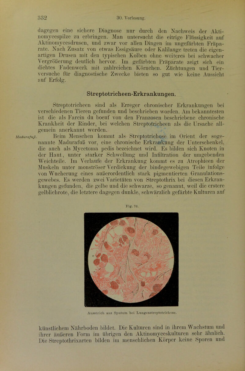 Madurafuß. dagegen eine sichere Diagnose nur durch den Nachweis der Akti- nomycespilze zu erbringen. Man untersucht die eitrige Flüssigkeit auf Aktinomy cesdrusen, und zwar vor allen Dingen im ungefärbten Präpa- rate. Nach Zusatz von etwas Essigsäure oder Kalilauge treten die eigen- artigen Drusen mit den typischen Kolben ohne weiteres bei schwacher Vergrößerung deutlich hervor. Im gefärbten Präparate zeigt sich ein dichtes Fadenwerk mit zahlreichen Körnchen. Züchtungen und Tier- versuche für diagnostische Zwecke bieten so gut wie keine Aussicht auf Erfolg. Streptotricheen-Ex’krankungen. Streptotricheen sind als Erreger chronischer Erkrankungen bei verschiedenen Tieren gefunden und beschrieben worden. Am bekanntesten ist die als Farcin du boeuf von den Franzosen beschriebene chronische Krankheit der Kinder, bei welchen Streptotricheen als die Ursache all- gemein anerkannt werden. Beim Menschen kommt als Streptotrichose im Orient der soge- nannte Madurafuß vor, eine chronische Erkrankung der Unterschenkel, die auch als Mycetoma pedis bezeichnet wird. Es bilden sich Knoten in der Haut, unter starker Schwellung und Infiltration der umgebenden Weichteile. Im Verlaufe der Erkrankung kommt es zu Atrophieen der Muskeln unter monströser Verdickung der bindegewebigen Teile infolge von Wucherung eines außerordentlich stark pigmentierten Granulations- gewebes. Es werden zwei Varietäten von Streptothrix bei diesen Erkran- kungen gefunden, die gelbe und die schwarze, so genannt, weil die erstere gelblichrote, die letztere dagegen dunkle, schwärzlich gefärbte Kulturen auf Fig. 76. Ausstrich aus Sputum bei LungenstroptotrichoBe. künstlichem Nährboden bildet. Die Kulturen sind in ihrem Wachstum und ihrer äußeren Form im übrigen den Aktinomyccskulturen sehr ähnlich. Die Streptothrixarten bilden im menschlichen Körper keine Sporen und