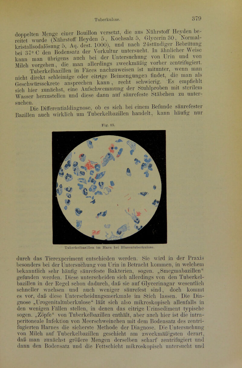 doppelten Menge einer Bouillon versetzt, die aus Nährstoff Heyden be- reitet wurde (Nährstoff Heyden 5, Kochsalz 5, Glycerin 30, Normal- kristallsodalösong 5, Aq. dest. 1000), und nach 24stündiger Bebrütung bei 37° C den Bodensatz der Vorkultur untersucht. In ähnlicher \\ eise kann man übrigens auch bei der Untersuchung von Urin und von Milch vorgehen, die man allerdings zweckmäßig vorher zentrifugiert. Tuberkelbazillen in Fäces nachzuweisen ist mitunter, wenn man nicht direkt schleimige oder eitrige Beimengungen findet, die man als Geschwürssekrete ansprechen kann , recht schwierig. Es empfiehlt sich hier zunächst, eine Aufschwemmung der Stuhlproben mit sterilem Wasser herzustellen und diese dann aut säurefeste Stäbchen zu untei- u^e pie Differentialdiagnose, ob es sich bei einem Befunde säurefester Bazillen auch wirklich um Tuberkelbazillen handelt, kann häufig nur Fig. 83. Tuberkelbazillen im Harn bei Blasentuberkulose. durch das Tierexperiment entschieden werden. Sic wird in der Praxis besonders bei der Untersuchung von Urin in Betracht kommen, in welchem bekanntlich sehr häutig säurefeste Bakterien, sogen. „Smegmabazillen“ gefunden werden. Diese unterscheiden sich allerdings von den Tuberkel- bazillen in der Regel schon dadurch, daß sie auf Glycerinagar wesentlich schneller wachsen und auch weniger säurefest sind, doch kommt es vor, daß diese Unterscheidungsmerkmale im Stich lassen. Die Dia- gnose „Urogenitaltuberkulose“ läßt sich also mikroskopisch allenfalls in den wenigen Fällen stellen, in denen das eitrige Urinsediment typische sogen. „Zöpfe“ von Tuberkelbazillen enthält, aber auch hier ist die intra- peritoneale Infektion von Meerschweinchen mit dem Bodensatz des zentri- fugierten Harnes die sicherste Methode der Diagnose. Die Untersuchung von Milch auf Tuberkelbazillen geschieht am zweckmäßigsten derart, daß man zunächst größere Mengen derselben scharf zentrifugiert und dann den Bodensatz und die Fettschicht mikroskopisch untersucht und