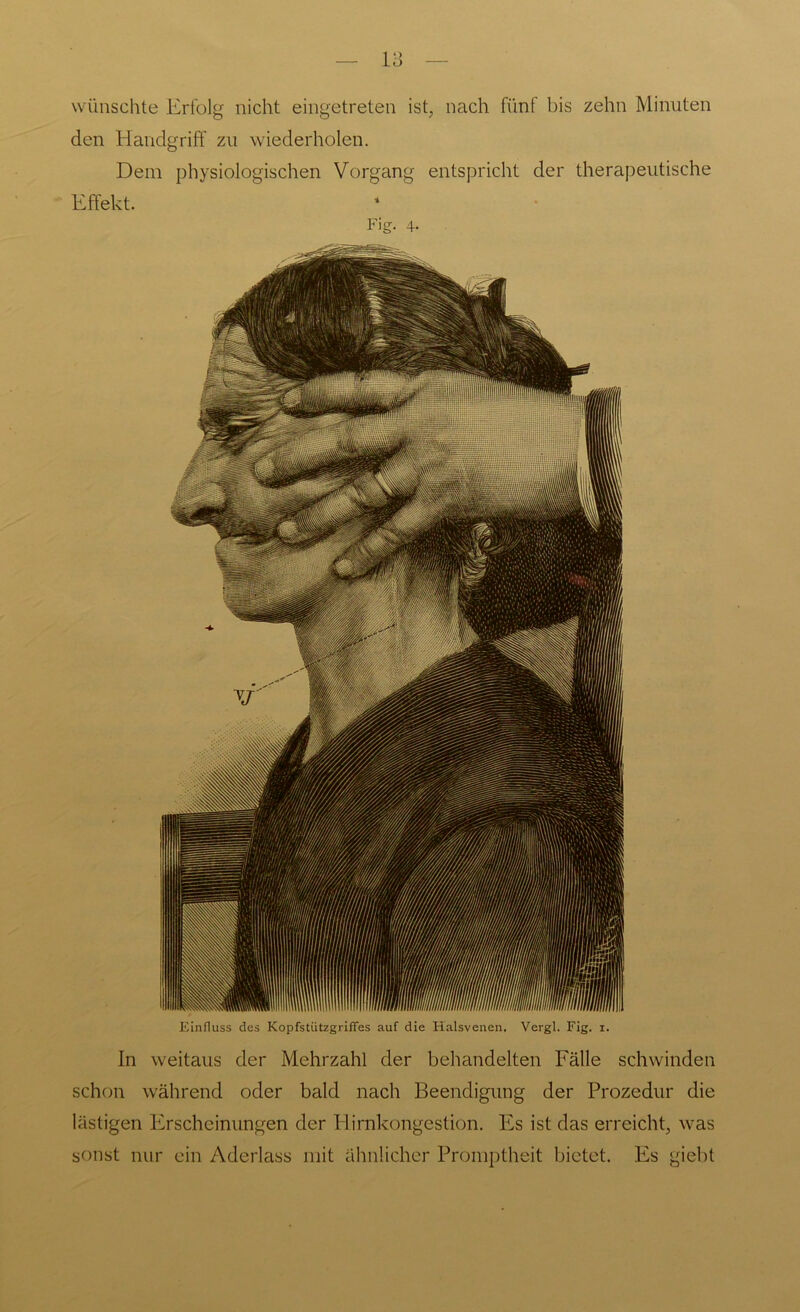 wünschte Erfolg nicht eingetreten ist, nach fünf bis zehn Minuten den Handgriff zu wiederholen. Dem physiologischen Vorgang entspricht der therapeutische Effekt. Einfluss des Kopfstiitzgriffes auf die Halsvenen. Vergl. Fig. i. In weitaus der Mehrzahl der behandelten Fälle schwinden schon während oder bald nach Beendigung der Prozedur die lästigen Erscheinungen der Hirnkongestion. Es ist das erreicht, was sonst nur ein Aderlass mit ähnlicher Promptheit bietet. Es giebt