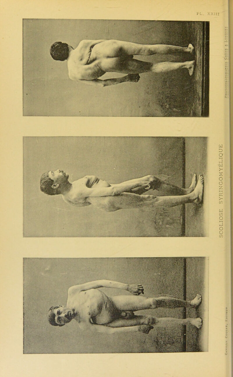 PL. XXIII SCOLIOSE SYRINGOMYELIQUE