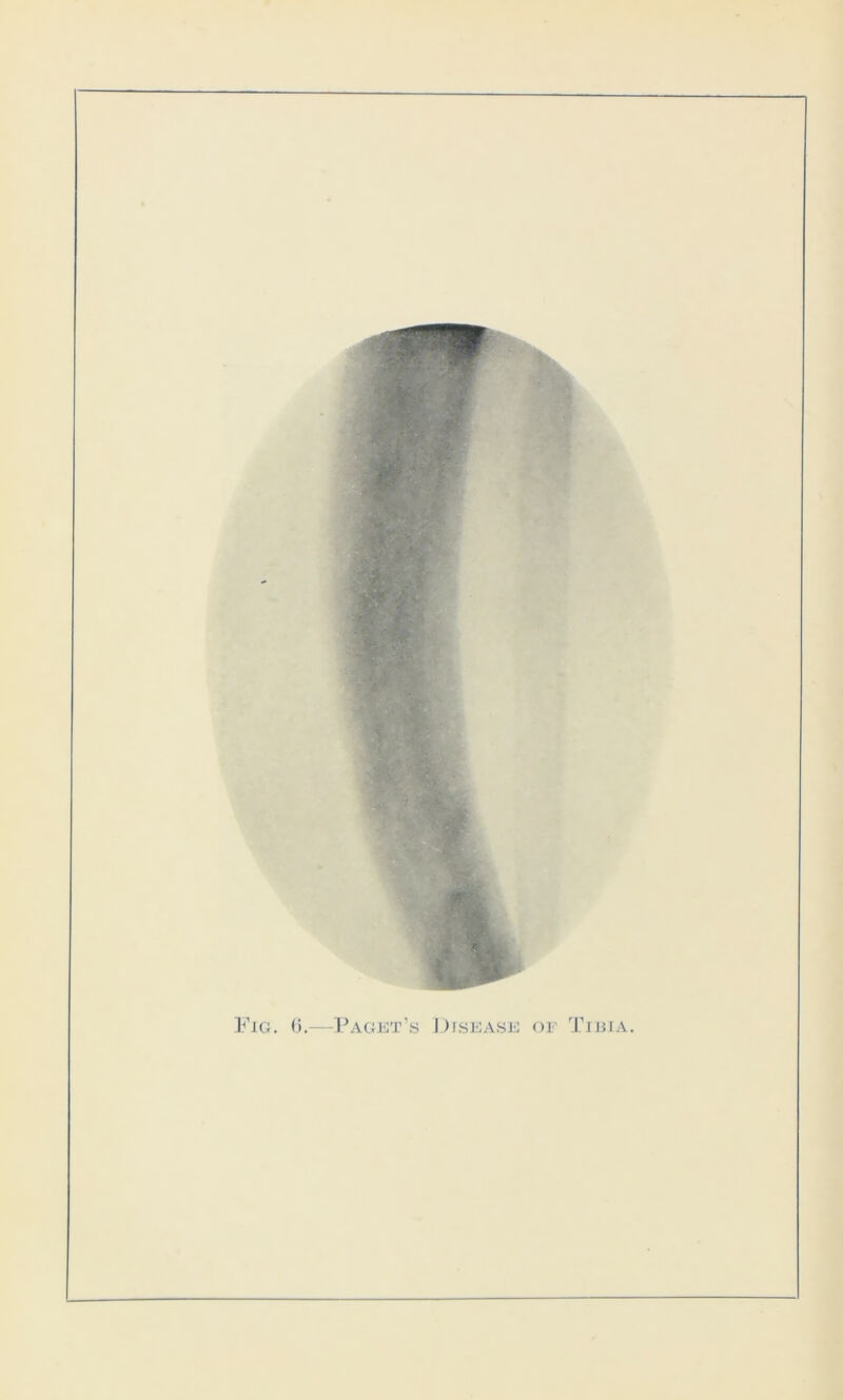 Fig. 6.—Paget’s Disease of Tibia.