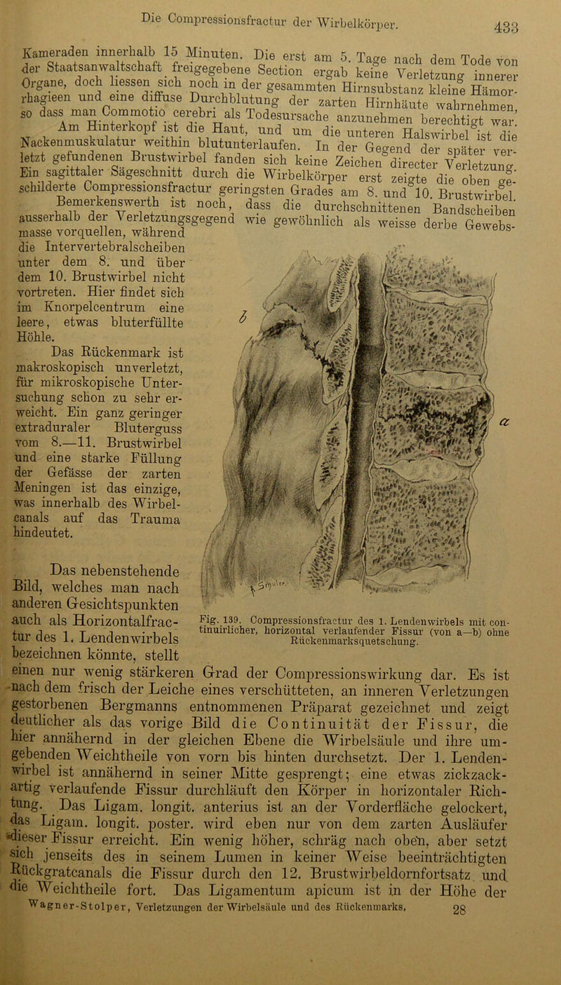 Kameraden innerhalb 15 Minuten. Die erst am 5. Tage nach dem Tode von der Staatsanwaltschaft freigegebene Section ergab keine Verletzung innere' Organe, doch liessen sich noch in der gesammten Hirnsubstanz kleine Hftmor- rhagieen und eine diffuse Durchblutung der zarten Hirnhäute wahrnehmen so dass man Commotio cerebn als Todesursache anzunehmen berechtigt war’ Am Hinterkopf ist die Haut, und um die unteren Halswirbel ist die Nackenmuskulatur weithin blutunterlaufen. In der Gegend der später ve letzt gefundenen Brustwirbel fanden sich keine Zeichen directer Verletzung Ein sagittaler Sägeschnitt durch die Wirbelkörper erst zeigte die oben ge- schilderte Compressionsfractur geringsten Grades am S. und 10. Brustwirbel Bemerkenswerth ist noch dass die durchschnittenen Bandscheiben ausserhalb der Verletzungsgegend wie gewöhnlich als weisse derbe Gewebe- masse vorquellen, während die Intervertebralscheiben unter dem 8. und über dem 10. Brustwirbel nicht vortreten. Hier findet sich im Knorpelcentrum eine leere, etwas bluterfüllte Höhle. Das Rückenmark ist makroskopisch unverletzt, für mikroskopische Unter- suchung schon zu sehr er- weicht. Ein ganz geringer extraduraler Bluterguss vom 8.—11. Brustwirbel und eine starke Füllung der Gefässe der zarten Meningen ist das einzige, was innerhalb des Wirbel- canals auf das Trauma hindeutet. IßM'j : * . W * ’0 4 .♦»>«/ ,, 4 u ^ PZr&tef Fig._l39. Compressionsfractur des 1. Lendenwirbels mit con- tinuirlieher, horizontal verlaufender Fissur (von a—b) ohne Rückenmarksquetschung. Das nebenstehende Bild, welches man nach anderen Gesichtspunkten auch als Horizontalfrac- tur des 1. Lendenwirbels bezeichnen könnte, stellt einen nur wenig stärkeren Grad der Compressionswirkung dar. Es ist -nach dem frisch der Leiche eines verschütteten, an inneren Verletzungen gestorbenen Bergmanns entnommenen Präparat gezeichnet und zeigt deutlicher als das vorige Bild die Continuität der Fissur, die bier annähernd in der gleichen Ebene die Wirbelsäule und ihre um- gebenden Weichtheile von vorn bis hinten durchsetzt. Der 1. Lenden- wirbel ist annähernd in seiner Mitte gesprengt; eine etwas zickzack - artig verlaufende Fissur durchläuft den Körper in horizontaler Bich- tung. Das Ligam. longit. anterius ist an der Vorderfläche gelockert, das Ligam. longit. poster. wird eben nur von dem zarten Ausläufer ^dieser Fissur erreicht. Ein wenig höher, schräg nach obeli, aber setzt sich jenseits des in seinem Lumen in keiner Weise beeinträchtigten Bückgratcanals die Fissur durch den 12. Brustwirbeldornfortsatz und die Weichtheile fort. Das Ligamentum apicum ist in der Höhe der Wagner-Stolper, Verletzungen der Wirbelsäule und des Rückenmarks. 28