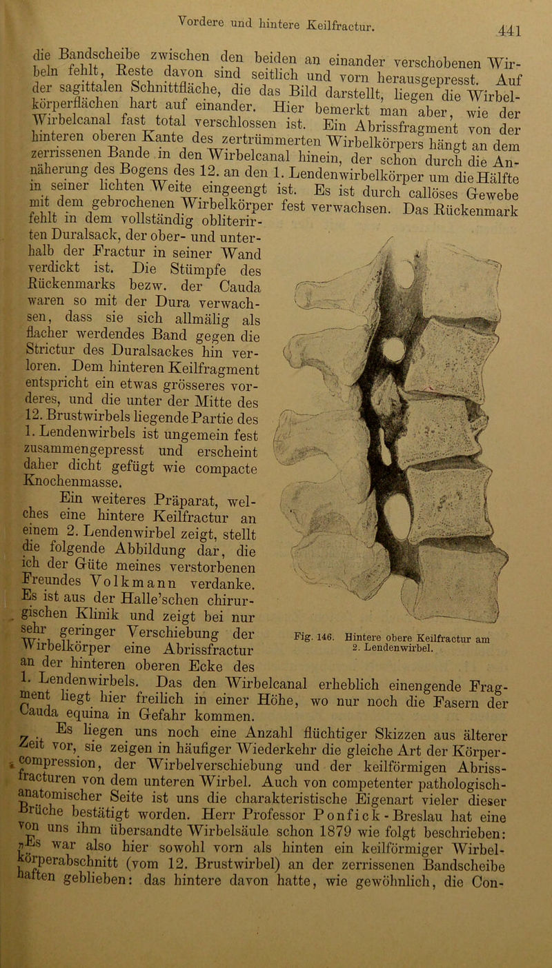 441 che Bandscheibe zwischen den beiden an einander verschobenen Wir- beln e i , Reste davon sind seitlich und vorn herausgepresst. Auf der sagittalen Schnittfläche, die das Bild darstellt, liegen die Wirbel- torperflachen hart auf einander. Hier bemerkt inan aber, wie der Wirbelcanal fast total verschlossen ist. Ein Abrissfragment von der hinteren oberen Kante des zertrümmerten Wirbelkörpers hängt an dem zerrissenen Bande m den Wirbelcanal hinein, der schon durch die An- naheiung des Bogens des 12. an den 1. Lendenwirbelkörper um dieHälfte ,n seiner lichten Weite eingeengt ist. Es ist durch callöses Gewebe mit dem gebrochenen Wirbelkörper fest verwachsen. Das Rückenmark fehlt m dem vollständig obliterir- ten Duralsack, der ober- und unter- halb der Fractur in seiner Wand verdickt ist. Die Stümpfe des Kückenmarks bezw. der Cauda waren so mit der Dura verwach- sen, dass sie sich allmälig als flacher werdendes Band gegen die Strictur des Duralsackes hin ver- loren. Dem hinteren Keilfragment entspricht ein etwas grösseres vor- deres, und die unter der Mitte des 12. Brustwirbels hegende Partie des 1. Lendenwirbels ist ungemein fest zusammengepresst und erscheint daher dicht gefügt wie compacte Knochenmasse. Ein weiteres Präparat, wel- ches eine hintere Keilfractur an einem 2. Lendenwirbel zeigt, stellt die folgende Abbildung dar, die ich der Güte meines verstorbenen Freundes Volkmann verdanke. Es ist aus der Halle’schen chirur- gischen Klinik und zeigt bei nur sehr geringer Verschiebung der an der hinteren oberen Ecke des L Lendenwirbels. Das den Wirbelcanal erheblich einengende Frag- ment hegt hier freilich in einer Höhe, wo nur noch die Fasern dei ^auda equina in Gefahr kommen. Es liegen uns noch eine Anzahl flüchtiger Skizzen aus älterei -£eit vor, sie zeigen in häufiger Wiederkehr die gleiche Art der Körper- compression, der Wirbelverschiebung und der keilförmigen Abriss- tracturen von dem unteren Wirbel. Auch von competenter pathologisch- anatomischer Seite ist uns die charakteristische Eigenart vieler dieser -Brüche bestätigt worden. Herr Professor Ponfick-Breslau hat eine von uns ihm übersandte Wirbelsäule schon 1879 wie folgt beschrieben: war also hier sowohl vorn als hinten ein keilförmiger Wirbel- örperabschnitt (vom 12. Brustwirbel) an der zerrissenen Bandscheibe alten geblieben: das hintere davon hatte, wie gewöhnlich, die Con- Fig. 146. Hintere obere Keilfractur am