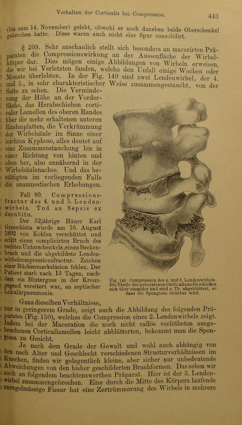 W ' Verhalten der Corticalis bei Compression. (bis zum 14. November) gelebt, obwohl er noch daneben beide Oberschenkel gebrochen hatte. Diese waren auch nicht eine Spur consolidirt. § 209. kein anschaulich stellt sich besonders an macerirten Prä- paraten die Compressionswirkung an der Aussenfläche der Wirbel- körper dar. Dies mögen einige Abbildungen von Wirbeln erweisen die wir bei Verletzten fanden, welche den Unfall einige Wochen oder Monate überlebten. In der Fig. 149 sind zwei Lendenwirbel, der 4. und 5., in sehr charakteristischer Weise zusammengestaucht, von der • Seite zu sehen. Die Verminde- rung der Höhe an der Vorder- fläche, das Herabschieben corti- caler Lamellen des oberen Landes über die mehr erhaltenen unteren Rindenplatten, die Verkrümmung der Wirbelsäule im Sinne einer leichten Kyphose, alles deutet auf eine Zusammen Stauchung hin in einer Richtung von hinten und oben her, also annähernd in der Wirbelsäulenachse. Und das be- stätigten im vorliegenden Falle die anamnestischen Erhebungen. Fall 80. Compressions- fractur des 4. und 5. Lenden- wirbels. Tod an Sepsis ex decubitu. Der 52jährige Häuer Karl Grzeschista wurde am 16. August 1892 von Kohlen verschüttet und erlitt einen complicirten Bruch des rechten Unterschenkels,einen Becken- bruch und die abgebildete Lenden- wirbelcompressionsfractur. Zeichen einer Rückenmarksläsion fehlen. Der Patient starb nach 13 Tagen, nach- dem ein Bluterguss in der Kreuz- gegend vereitert war, an septischer Lobulärpneumonie. Fig. 149. Compression des 4. und 5. LendernWirbels. Die Tlieile der geborstenen CorticallameUe schieben sich über einander und sind z.Th. abgeblättert, so dass die Spongiosa sichtbar wird. Ganz dieselben Verhältnisse, nur in geringerem Grade, zeigt auch die Abbildung des folgenden Prä- parates (Fig. 150), welches die Compression eines 2. Lendenwirbels zeigt. Indem bei der Maceration die noch nicht callös verlötheten ausge- brochenen Corticallamellen leicht abblätterten, bekommt man die Sj>on- £iosa zu Gesicht. Je nach dem Grade der Gewalt und wohl auch abhängig von nach Alter und Geschlecht verschiedenen StructurVerhältnissen im ' Knochen, finden wir gelegentlich kleine, aber sicher nur unbedeutende Abweichungen von den bisher geschilderten Bruchformen. Das selten wir auch an folgendem beachtenswerthen Präparat. Hier ist der 3. Lenden- wirbel zusammengebrochen. Eine durch die Mitte des Körpers laufende unregelmässige Fissur hat eine Zertrümmerung des Wirbels in melnere