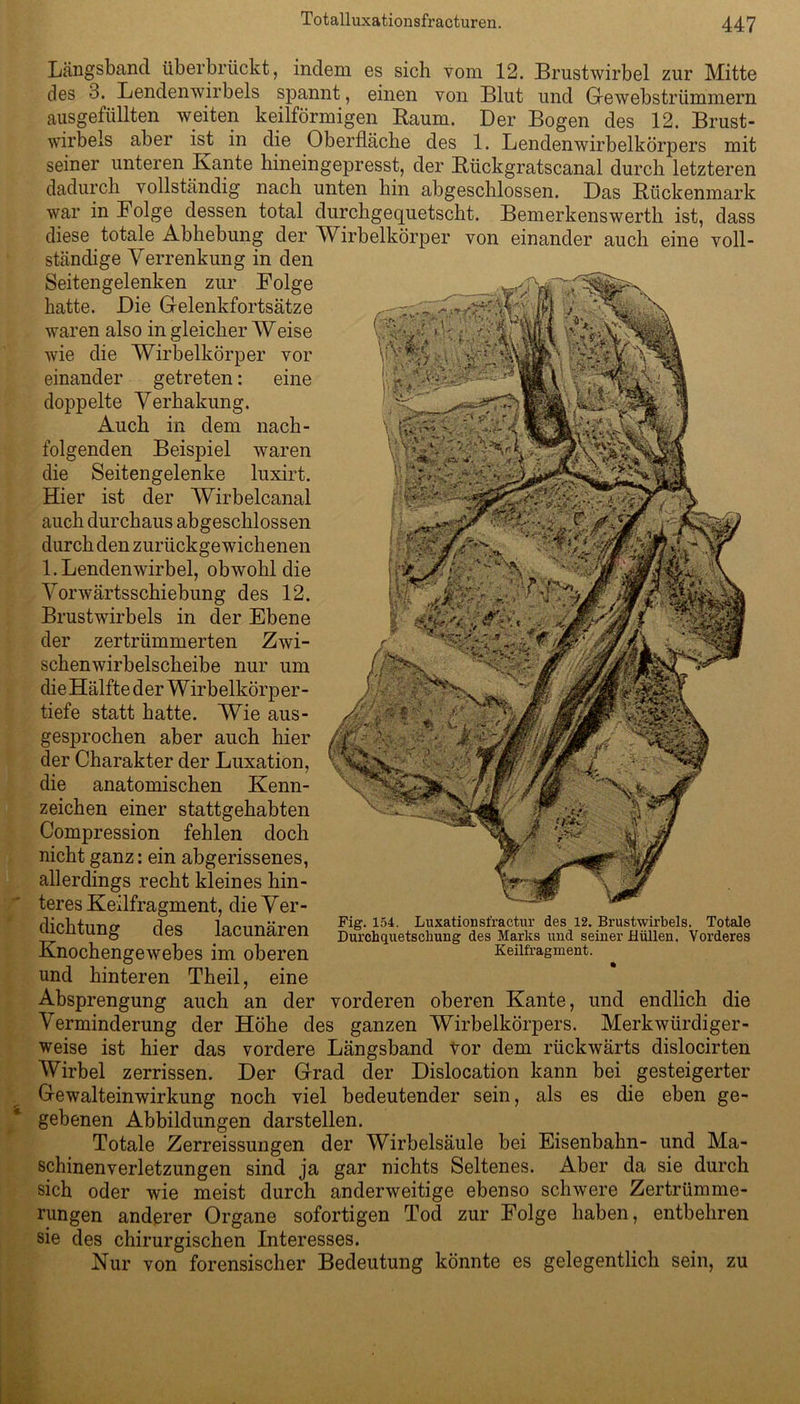 ' & Längsband überbrückt, indem es sich vom 12. Brustwirbel zur Mitte des 3. Lendenwirbels spannt, einen von Blut und Gewebstrümmern ausgefüllten weiten keilförmigen Baum. Der Bogen des 12. Brust- wirbels aber ist in die Oberfläche des 1. Lendenwirbelkörpers mit seiner unteren Kante bineingepresst, der Biickgratscanal durch letzteren dadurch vollständig nach unten hin abgeschlossen. Das Bückenmark war in Folge dessen total durchgequetscht. Bemerkenswerth ist, dass diese totale Abhebung der Wirbelkörper von einander auch eine voll- ständige Verrenkung in den Seitengelenken zur Folge hatte. Die Gelenkfortsätze waren also in gleicher Weise wie die Wirbelkörper vor einander getreten: eine doppelte Verhakung. Auch in dem nach- folgenden Beispiel waren die Seitengelenke luxirt. Hier ist der Wirbelcanal auch durchaus abgeschlossen durch den zurückgewichenen 1. Lendenwirbel, obwohl die Vorwärtsschiebung des 12. Brustwirbels in der Ebene der zertrümmerten Zwi- schenwirbelscheibe nur um die Hälfte der Wirbelkörper- tiefe statt hatte. Wie aus- gesprochen aber auch hier der Charakter der Luxation, die anatomischen Kenn- zeichen einer stattgehabten Compression fehlen doch nicht ganz: ein abgerissenes, allerdings recht kleines hin- teres Keilfragment, die Ver- dirhtnno- rloc laminarem Fig. 154. Luxationsfractur des 12. Brustwirbels. Totale ^niung ues lacunaren Durch quetschung des Marks und seiner Hüllen. Vorderes Knochengewebes im oberen Keilfragment, und hinteren Theil, eine Absprengung auch an der vorderen oberen Kante, und endlich die Verminderung der Höhe des ganzen Wirbelkörpers. Merkwürdiger- weise ist hier das vordere Längsband vor dem rückwärts dislocirten Wirbel zerrissen. Der Grad der Dislocation kann bei gesteigerter Gewalteinwirkung noch viel bedeutender sein, als es die eben ge- gebenen Abbildungen darstellen. Totale Zerreissungen der Wirbelsäule bei Eisenbahn- und Ma- schinenverletzungen sind ja gar nichts Seltenes. Aber da sie durch sich oder wie meist durch anderweitige ebenso schwere Zertrümme- rungen anderer Organe sofortigen Tod zur Folge haben, entbehren sie des chirurgischen Interesses. Nur von forensischer Bedeutung könnte es gelegentlich sein, zu