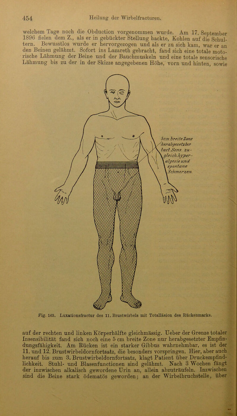 welchem Tage noch die Obduction vorgenommen wurde. Am 17. September 1896 fielen dem Z., als er in gebückter Stellung hackte, Kohlen auf die Schul- tern. Bewusstlos wurde er hervorgezogen und als er zu sich kam, war er an den Beinen gelähmt. Sofort ins Lazareth gebracht, fand sich eine totale moto- rische Lähmung der Beine und der Bauchmuskeln und eine totale sensorische Lähmung bis zu der in der Skizze angegebenen Höhe, vorn und hinten, sowie in W/MM i 5cm 1)reite Zone /herabgesetxler tact.Sens. zu- gleich hyper - i algesie und spontane {Schmerzen. Fig. 163. Luxationsfractur des 11. Brustwirbels mit Totalläsion des Rückenmarks. auf der rechten und linken Körperhälfte gleichmässig. Ueber der Grenze totaler Insensibilität fand sich noch eine 5 cm breite Zone nur herabgesetzter Empfin- dungsfähigkeit. Am Rücken ist ein starker Gibbus wahrnehmbar, es ist der 11. und 12. Brustwirbeldornfortsatz, die besonders vorspringen. Hier, aber auch herauf bis zum 3. Brustwirbeldornfortsatz, klagt Patient über Druckempfind- lichkeit. Stuhl- und Blasenfunctionen sind gelähmt. Nach 3 Wochen fängt der inzwischen alkalisch gewordene Urin an, allein abzuträufeln. Inzwischen sind die Beine stark ödematös geworden; an der Wirbelbruchstelle, über
