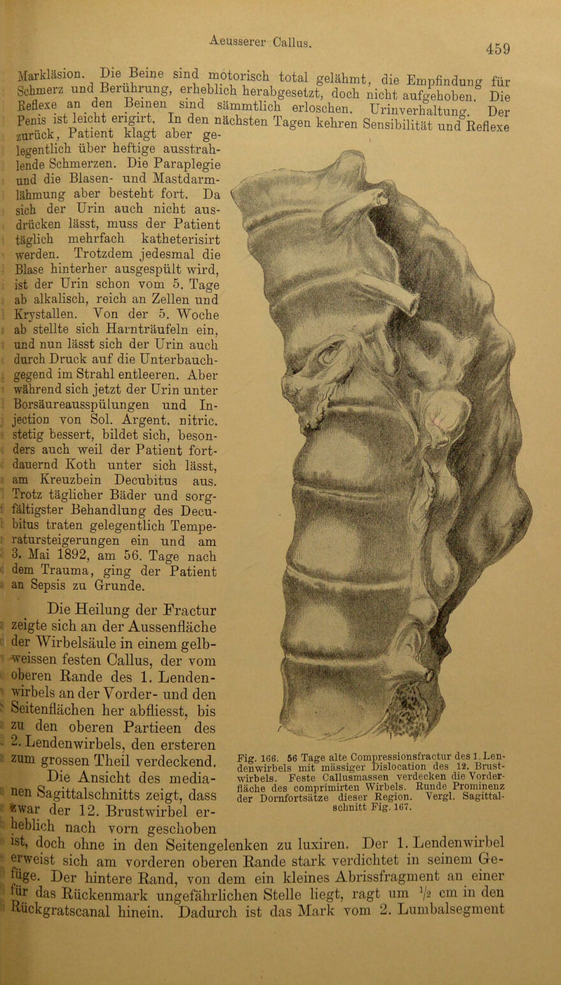 459 Martlasion. Die Beine sind motorisch total gelähmt, die Empfindung für Schmerz und Berührung, erheblich herabgesetzt, doch nicht aufgehoben Die Beflexe an _ den Beinen sind sämmtlich erloschen. Urinverhaltung. Der Penis ist leicht erignt. In den nächsten Tagen kehren Sensibilität und Reflexe zuruck, Patient klagt aber ge- legentlich über heftige ausstrah- lende Schmerzen. Die Paraplegie und die Blasen- und Mastdarm- lähmung aber besteht fort. Da sich der Urin auch nicht aus- drücken lässt, muss der Patient täglich mehrfach katheterisirt werden. Trotzdem jedesmal die Blase hinterher ausgespült wird, ist der Urin schon vom 5. Tage ab alkalisch, reich an Zellen und Krystallen. Yon der 5. Woche ab stellte sich Harn träufeln ein, und nun lässt sich der Urin auch durch Druck auf die Unterbauch- gegend im Strahl entleeren. Aber während sich jetzt der Urin unter Borsäureausspülungen und In- jection von Sol. Argent. nitric. stetig bessert, bildet sich, beson- ders auch weil der Patient fort- dauernd Koth unter sich lässt, am Kreuzbein Decubitus aus. Trotz täglicher Bäder und sorg- fältigster Behandlung des Decu- bitus traten gelegentlich Tempe- ratursteigerungen ein und am 3. Mai 1892, am 56. Tage nach dem Trauma, ging der Patient an Sepsis zu Grunde. Die Heilung der Fractur zeigte sich an der Aussenfläche der Wirbelsäule in einem gelb- weissen festen Callus, der vom oberen Rande des 1. Lenden- wirbels an der Vorder- und den Seitenflächen her abfliesst, bis zu den oberen Partieen des 2. Lendenwirbels, den ersteren zum grossen Theil verdeckend. Die Ansicht des media- nen Sagittalschnitts zeigt, dass ewar der 12. Brustwirbel er- heblich nach vorn geschoben ist, doch ohne in den Seitengelenken zu luxiren. Der 1. Lendenwirbel erweist sich am vorderen oberen Bande stark verdichtet in seinem Ge- füge. Der hintere Band, von dem ein kleines Abrissfragment an einer für das Bückenmark ungefährlichen Stelle liegt, ragt um V2 cm in deu Rückgratscanal hinein. Dadurch ist das Mark vom 2. Lumbalsegment Fig. 166. 56 Tage alte Compressionsfractur des 1. Len- denwirbels mit massiger Dislocation des 12. Brust- wirbels. Feste Callusmassen verdecken die Vorder- fläclie des comprimirten Wirbels. Runde Prominenz der Dornfortsätze dieser Region. Yergl. Sagittal- scbnitt Fig. 167.