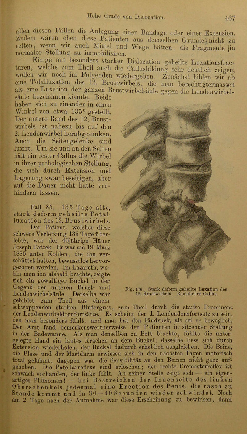 allen diesen Fällen die Anlegung einer Bandage oder einer Extension. Zudem wären eben diese Patienten ans demselben Gründet nicht zu retten, wenn wir auch Mittel und Wege hätten, die Fragmente [in normaler Stellung zu immobilisiren. Einige mit besonders starker Dislocation geheilte Luxationsfrac- tuien, welche zum 4 heil auch die Callusbildung sehr deutlich zeigen, wollen wii noch im Folgenden wiedergeben. Zunächst bilden wir ab eine Totalluxation des 12. Brustwirbels, die man berechtigtennassen als eine Luxation dei ganzen Brustwiroelsäule gegen die Lendenwirbel- säule bezeichnen könnte. Beide haben sich zu einander in einen Winkel von etwa 135° gestellt. Der untere Rand des 12. Brust- wirbels ist nahezu bis auf den 2. Lendenwirbel herabgesunken. Auch die Seitengelenke sind luxirt. Um sie und an den Seiten hält ein fester Callus die Wirbel in ihrer pathologischen Stellung, die sich durch Extension und Lagerung zwar beseitigen, aber auf die Dauer nicht hatte ver- hindern lassen. Fall 85. 135 Tage alte, stark deform geheilte Total- luxation des 12. Brustwirbels. Der Patient, welcher diese schwere Verletzung 135 Tage über- lebte, war der 46jährige Häuer Joseph Patzek. Er war am 19. März 1886 unter Kohlen, die ihn ver- schüttet hatten, bewusstlos hervor- gezogen worden. Im Lazareth, wo- hin man ihn alsbald brachte, zeigte sich ein gewaltiger Buckel in der Gegend der unteren Brust- und Lendenwirbelsäule. Derselbe war gebildet zum Theil aus einem schwappenden starken Bluterguss, zum Theil durch die starke Prominenz der Lendenwirbeldornfortsätze. Es scheint der 1. Lendendornfortsatz zu sein, den man besonders fühlt, und man hat den Eindruck, als sei er beweglich. Der Arzt fand bemerkenswertherweise den Patienten in sitzender Stellung in der Badewanne. Als man denselben zu Bett brachte, fühlte die unter- gelegte Hand ein lautes Krachen an dem Buckel; dasselbe liess sich durch Extension wiederholen, der Buckel dadurch erheblich ausgleicben. Die Beine, die Blase und der Mastdarm erwiesen sich in den nächsten Tagen motorisch total gelähmt, dagegen war die Sensibilität an den Beinen nicht ganz auf- gehoben. Die Patellarreflexe sind erloschen; der rechte Cremasterreflex ist schwach vorhanden, der linke fehlt. An seiner Stelle zeigt sich — ein eigen- artiges Phänomen! — bei Bestreichen der Innenseite des linken Oberschenkels jedesmal eine Erection des Penis, die rasch zu Stande kommt und in 30 — 40 Secun den wieder schwindet. Noch am 2. Tage nach der Aufnahme war diese Erscheinung zu bewirken, dann Fig. 176. Stark deform geheilte Luxation des 12. Brustwirbels. Reichlicher Callus.