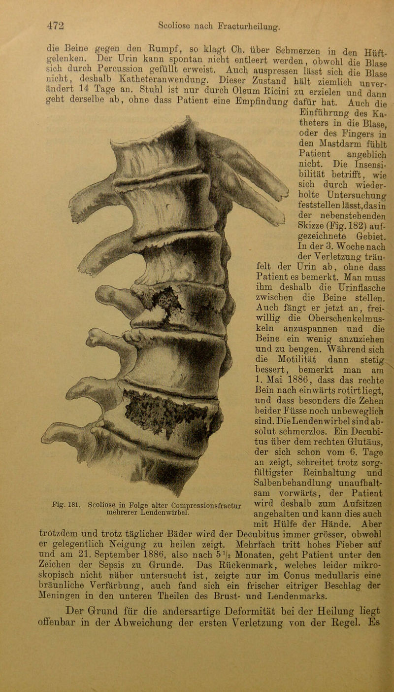 die Beine gegen den Rumpf, so klagt Oh. über Schmerzen in den Hüft- gelenken. Der Urin kann spontan, nicht entleert werden, obwohl die Blase sich durch Percussion gefüllt erweist. Auch auspressen lässt sich die Blase nicht, deshalb Katheteranwendung. Dieser Zustand hält ziemlich unver- ändert. 14 läge an. Stuhl ist nur durch Oleum Ricini zu erzielen und dann geht derselbe ab, ohne dass Patient eine Empfindung dafür hat. Auch die Einführung des Ka- theters in die Blase, oder des Fingers in den Mastdarm fühlt Patient angeblich nicht. Die Insensi- bilität betrifft, wie sich durch wieder- holte Untersuchung feststellen lässt,das in der nebenstehenden Skizze (Fig. 182) auf- gezeichnete Gebiet. In der 3. Woche nach der Verletzung träu- felt der Urin ab, ohne dass Patient es bemerkt. Man muss ihm deshalb die Urinflasche zwischen die Beine stellen. Auch fängt er jetzt an, frei- willig die Oberschenkelmus- keln anzuspannen und die Beine ein wenig anzuziehen und zu beugen. Während sich die Motilität dann stetig bessert, bemerkt man am 1. Mai 1886, dass das rechte Bein nach einwärts rotirt liegt, und dass besonders die Zehen beider Füsse noch unbeweglich sind. Die Lendenwirbel sind ab- solut schmerzlos. Ein Decubi- tus über dem rechten Glutäus, der sich schon vom 6. Tage an zeigt, schreitet trotz sorg- fältigster Reinhaltung und Fig. 181. Scoliose in Folge alter Compressionsfractur mehrerer Lendenwirbel. Salbenbehandlung unaufhalt sam vorwärts, der Patient wird deshalb zum Aufsitzen angehalten und kann dies auch mit Hülfe der Hände. Aber trotzdem und trotz täglicher Bäder wird der Decubitus immer grösser, obwohl er gelegentlich Neigung zu heilen zeigt. Mehrfach tritt hohes Fieber auf und am 21. September 1886, also nach 5Monaten, geht Patient unter den Zeichen der Sepsis zu Grunde. Das Rückenmark, welches leider mikro- skopisch nicht näher untersucht ist, zeigte nur im Conus medullaris eine bräunliche Verfärbung, auch fand sich ein frischer eitriger Beschlag der Meningen in den unteren Theilen des Brust- und Lendenmarks. Der Grund für die andersartige Deformität bei der Heilung liegt offenbar in der Abweichung der ersten Verletzung von der Regel. Es