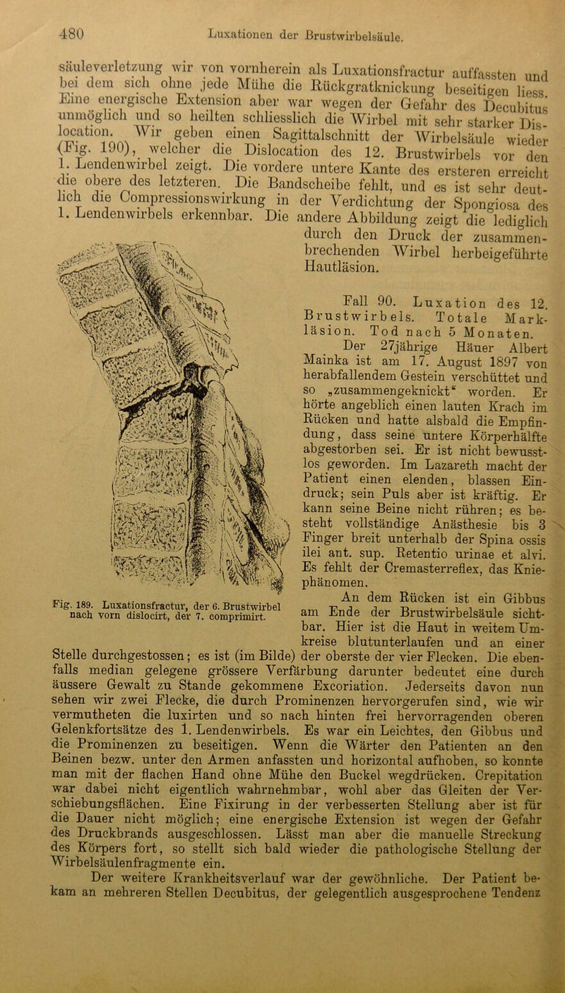 sauleverletzung wir von vornherein als Luxationsfractur auffassten und hei dem sich ohne jede Mühe die Eückgratknickung beseitigen Hess Eine energische Extension aber war wegen der Gefahr des Decubitus unmöglich und so heilten schliesslich die Wirbel mit sehr starker Dis- location Wir geben einen Sagittalschnitt der Wirbelsäule wieder (Iig. 190), welcher die Dislocation des 12. Brustwirbels vor den 1 Lendenwirbel zeigt. Die vordere untere Kante des ersteren erreicht (He obere des letzteren. Die Bandscheibe fehlt, und es ist sehr deut- lich die Compressionswirkung in der Verdichtung der Spongiosa des 1. Lendenwirbels erkennbar. Die andere Abbildung zeigt die lediglich ... r durch den Druck der zusammen- brechenden Wirbel herbeigeführte Hautläsion. tefeäfi ü§ »f Fall 90. Luxation des 12. Brustwirbels. Totale Mark- läsion. Tod nach 5 Monaten. Der 27jährige Häuer Albert Mainka ist am 17. August 1897 von herabfallendem Gestein verschüttet und so „zusammengeknickt“ worden. Er hörte angeblich einen lauten Krach im Rücken und hatte alsbald die Empfin- dung, dass seine untere Körperhälfte abgestorben sei. Er ist nicht bewusst- los geworden. Im Lazareth macht der Patient einen elenden, blassen Ein- druck; sein Puls aber ist kräftig. Er kann seine Beine nicht rühren; es be- steht vollständige Anästhesie bis 3 Finger breit unterhalb der Spina ossis ilei ant. sup. Retentio urinae et alvi. Es fehlt der Cremasterreflex, das Knie- phänomen. An dem Rücken ist ein Gibbus am Ende der Brustwirbelsäule sicht- bar. Hier ist die Haut in weitem Um- kreise blutunterlaufen und an einer Stelle durchgestossen; es ist (im Bilde) der oberste der vier Flecken. Die eben- falls median gelegene grössere Verfärbung darunter bedeutet eine durch äussere Gewalt zu Stande gekommene Excoriation. Jederseits davon nun sehen wir zwei Flecke, die durch Prominenzen hervorgerufen sind, wie wir vermutheten die luxirten und so nach hinten frei hervorragenden oberen Gelenkfortsätze des 1. Lendenwirbels. Es war ein Leichtes, den Gibbus und die Prominenzen zu beseitigen. Wenn die Wärter den Patienten an den Beinen bezw. unter den Armen anfassten und horizontal aufhoben, so konnte man mit der flachen Hand ohne Mühe den Buckel wegdrücken. Crepitation war dabei nicht eigentlich wahrnehmbar, wohl aber das Gleiten der Ver- schiebungsflächen. Eine Fixirung in der verbesserten Stellung aber ist für die Dauer nicht möglich; eine energische Extension ist wegen der Gefahr des Druckbrands ausgeschlossen. Lässt man aber die manuelle Streckung des Körpers fort, so stellt sich bald wieder die pathologische Stellung der Wirbelsäulenfragmente ein. Der weitere Krankheitsverlauf war der gewöhnliche. Der Patient be- kam an mehreren Stellen Decubitus, der gelegentlich ausgesprochene Tendenz Fig. 189. Luxationsfractur, der 6. Brustwirbel nach vorn dislocirt, der 7. comprimirt.