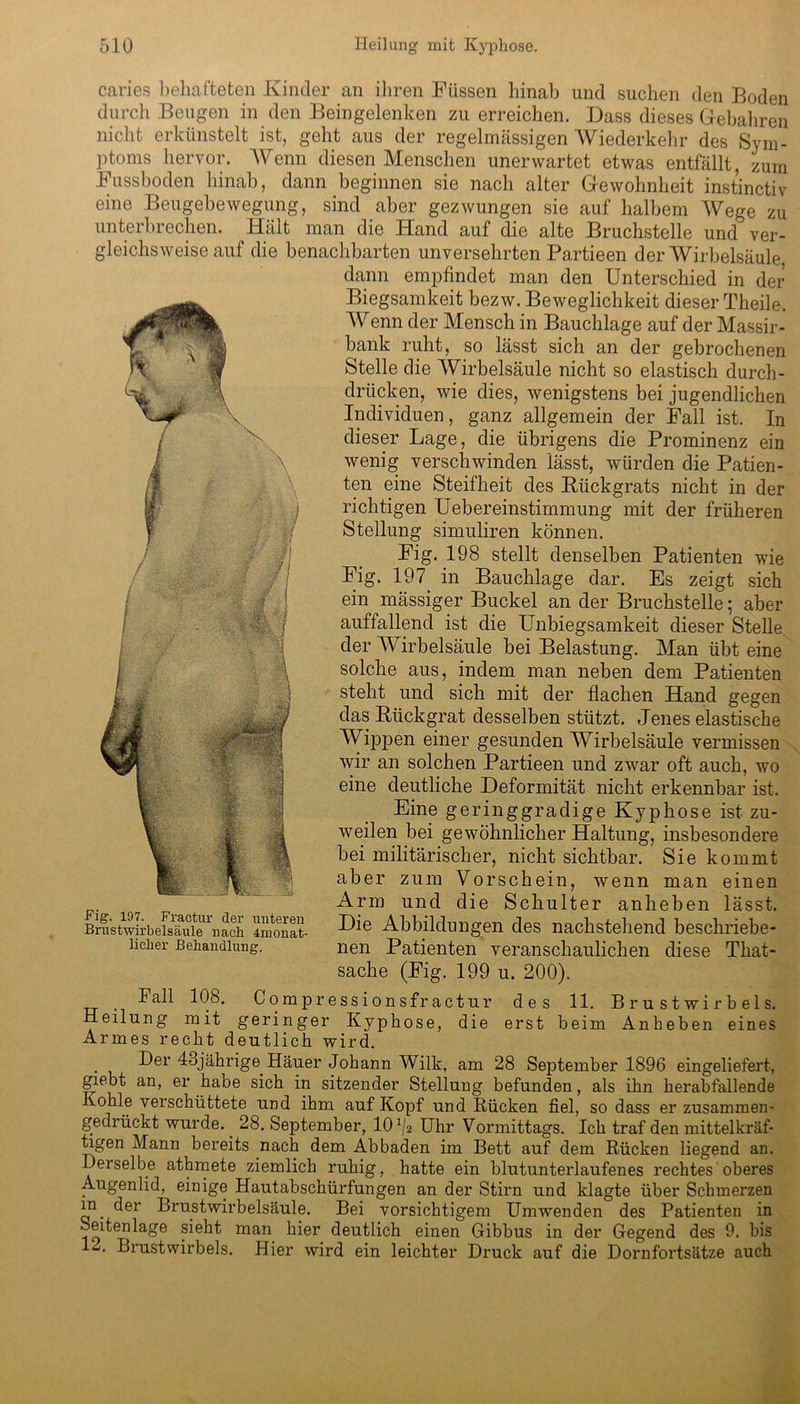 caries behafteten Kinder an ihren Füssen hinab und suchen den Boden durch Beugen in den Beingelenken zu erreichen. Dass dieses Gfebahren nicht erkünstelt ist, geht aus der regelmässigen Wiederkehr des Sym- ptoms hervor. Wenn diesen Menschen unerwartet etwas entfällt, zum Fussboden hinab, dann beginnen sie nach alter Gewohnheit instinctiv eine Beugebewegung, sind aber gezwungen sie auf halbem Wege zu unterbrechen. Hält man die Hand auf die alte Bruchstelle und ver- gleichsweise auf die benachbarten unversehrten Partieen der Wirbelsäule dann empfindet man den Unterschied in der Biegsamkeit bezw. Beweglichkeit dieser Theile. Wenn der Mensch in Bauchlage auf der Massir- bank ruht, so lässt sich an der gebrochenen Stelle die Wirbelsäule nicht so elastisch durch- drücken, wie dies, wenigstens bei jugendlichen Individuen, ganz allgemein der Fall ist. In dieser Lage, die übrigens die Prominenz ein wenig verschwinden lässt, würden die Patien- ten eine Steifheit des Rückgrats nicht in der richtigen Uebereinstimmung mit der früheren Stellung simuliren können. Fig. 198 stellt denselben Patienten wie Fig. 197 in Bauchlage dar. Es zeigt sich ein mässiger Buckel an der Bruchstelle; aber auffallend ist die Unbiegsamkeit dieser Stelle der Wirbelsäule bei Belastung. Man übt eine solche aus, indem man neben dem Patienten steht und sich mit der flachen Hand gegen das Rückgrat desselben stützt. Jenes elastische Wippen einer gesunden Wirbelsäule vermissen wir an solchen Partieen und zw7ar oft auch, wo eine deutliche Deformität nicht erkennbar ist. Eine geringgradige Kyphose ist zu- weilen bei gewöhnlicher Haltung, insbesondere bei militärischer, nicht sichtbar. Sie kommt aber zum Vorschein, wenn man einen Arm und die Schulter anheben lässt. BrlkwirbeSSrnach 4monat- Abbildungen des nachstehend beschriebe- iicher Behandlung. nen Patienten veranschaulichen diese That- sache (Fig. 199 u. 200). . Fall 10b. Gompressionsfractur des 11. Brustwirbels. Heilung mit geringer Kyphose, die erst beim Anbeben eines Armes recht deutlich wird. Der lojährige Häuer Johann Wilk, am 28 September 1896 eingeliefert, giebt an, er habe sich in sitzender Stellung befunden, als ihn herabfallende Kohle verschüttete und ihm auf Kopf und Rücken fiel, so dass er zusammen- gedrückt wurde.. 28. September, 10 ^2 Uhr Vormittags. Ich traf den mittelkräf- tigen Mann bereits nach dem Abbaden im Bett auf dem Rücken liegend an. Derselbe athmete ziemlich ruhig, hatte ein blutunterlaufenes rechtes oberes Augenlid, einige Hautabschürfungen an der Stirn und klagte über Schmerzen m der Brustwirbelsäule. Bei vorsichtigem Umwenden des Patienten in Seitenlage sieht man hier deutlich einen Gibbus in der Gegend des 9. bis 2. Brustwirbels. Hier wird ein leichter Druck auf die Dornfortsätze auch