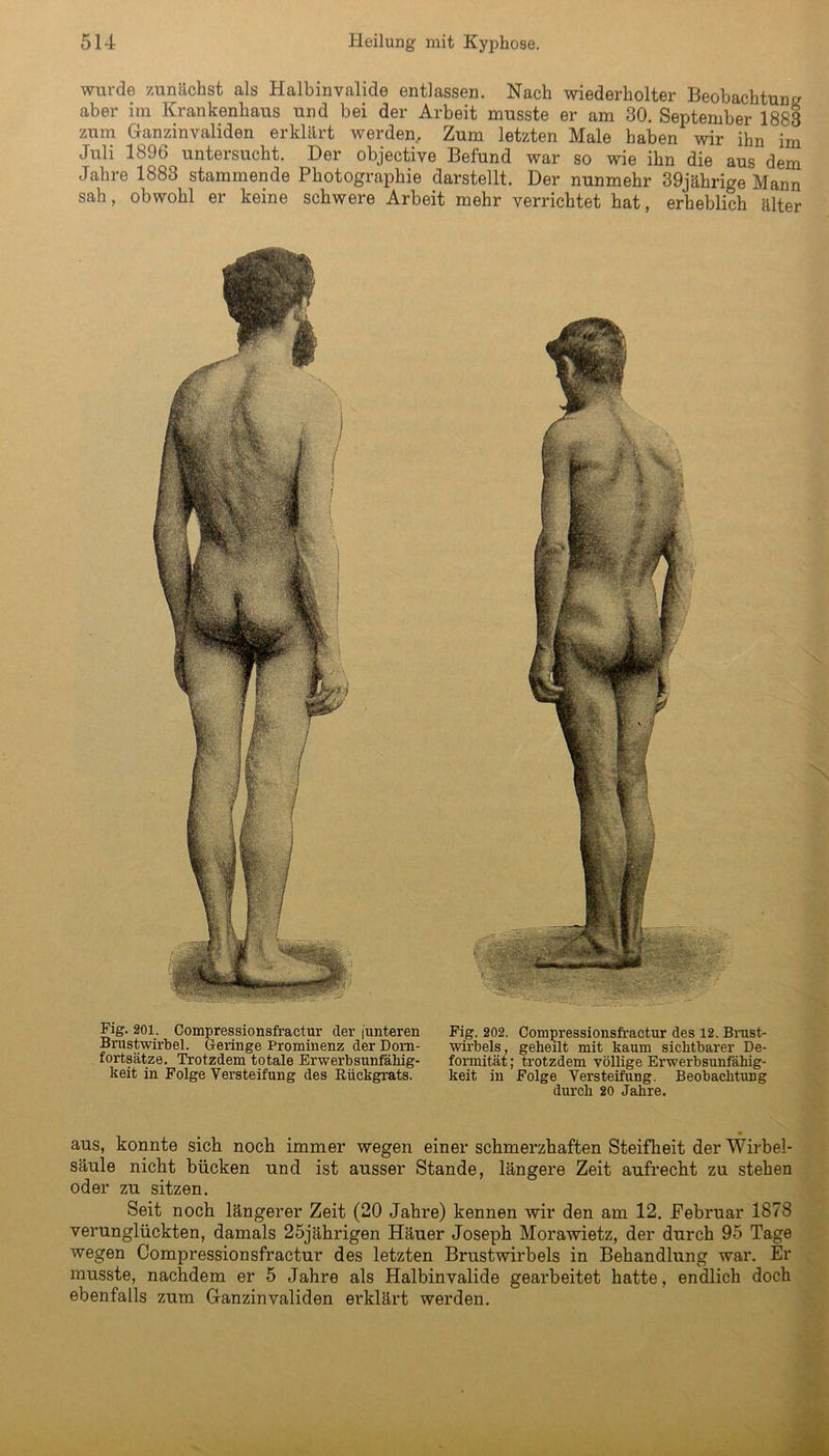 wurde zunächst als Halbinvalide entlassen. Nach wiederholter Beobachtung aber im Krankenhaus und bei der Arbeit musste er am 30. September 1883 zum Ganzinvaliden erklärt werden. Zum letzten Male haben wir ihn im Juli 1896 untersucht. Der objective Befund war so wie ihn die aus dem Jahre 1883 stammende Photographie darstellt. Der nunmehr 39jährige Mann sah, obwohl er keine schwere Arbeit mehr verrichtet hat, erheblich älter Fig. 201. Compressionsfractur der [unteren Fig. 202. Compressionsfractur des 12. Brust- Brustwirbel. Geringe Prominenz der Dora- Wirbels, geheilt mit kaum sichtbarer De- fortsätze. Trotzdem totale Erwerbsunfähig- formität; trotzdem völlige Erwerbsunfähig- keit in Folge Versteifung des Rückgrats. keit in Folge Versteifung. Beobachtung durch 20 Jahre. aus, konnte sich noch immer wegen einer schmerzhaften Steifheit der Wirbel- säule nicht bücken und ist ausser Stande, längere Zeit aufrecht zu stehen oder zu sitzen. Seit noch längerer Zeit (20 Jahre) kennen wir den am 12. Februar 1878 verunglückten, damals 25jährigen Häuer Joseph Morawietz, der durch 95 Tage wegen Compressionsfractur des letzten Brustwirbels in Behandlung war. Er musste, nachdem er 5 Jahre als Halbinvalide gearbeitet hatte, endlich doch ebenfalls zum Ganzinvaliden erklärt werden.