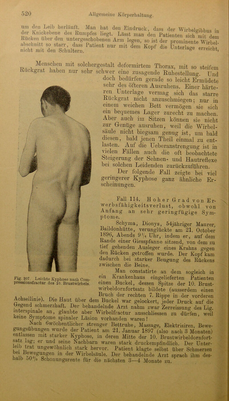 lim den Leib lierläuft. Man hat den Eindruck, dass der Wirbelgibbus in der Kmckebene des Rumpfes liegt. Lässt man den Patienten sich mit dem Bucken Uber den untergeschobenen Arm legen, so ist der prominente Wirte? KtaSÄ“nurm!t demKopf dieUnterlage Menschen mit solchergestalt deformirtem Thorax, mit so steifem Kuckgrat haben nur sehr schwer eine zusagende Ruhestellung. Und doch bedürfen gerade so leicht Ermüdete sehr des öfteren Ausruhens. Einer härte- ren Unterlage vermag sich das starre Rückgrat nicht anzuschmiegen • nur in einem weichen Bett vermögen sie sich ein bequemes Lager zurecht zu machen. Abei ^ auch im Sitzen können sie nicht zur Genüge ausruhen, weil die Wirbel- säule nicht biegsam genug ist, um bald diesen, bald jenen Theil einmal zu ent- lasten. Auf die Ueberanstrengung ist in vielen Eällen auch die oft beobachtete Steigerung der Sehnen- und Hautreflexe bei solchen Leidenden zurückzuführen. Her folgende Eall zeigte bei viel geringerer Kyphose ganz ähnliche Er- scheinungen. Fall 114. Hoher Grad von E r- werbsfähigkeits Verlust, obwohl von Anfang an sehr geringfügige Sym- ptome. Schyma, Dionys, 54jähriger Maurer, Bailclonhütte, verunglückte am 21. October 1896, Abends 9J/4 Uhr, indem er, auf dem Rande einer Giesspfanne sitzend, von dem zu tief gehenden Ausleger eines Krahns gegen den Rücken getroffen wurde. Der Kopf kam dadurch bei starker Beugung des Rückens zwischen die Beine. Man constatirte an dem sogleich in ein Krankenhaus eingelieferten Patienten einen Buckel, dessen Spitze der 10. Brust- wirbeldornfortsatz bildete (ausserdem einen rr Bruch der rechten 7. Rippe in der vorderen Acnsellinie). Die Haut über dem Buckel war gelockert, jeder Druck auf die Gegend schmerzhaft. Der behandelnde Arzt nahm zwar Zerreissung des Lig. interspinale an, glaubte aber Wirbelfractur ausschliessen zu dürfen, weil üeme Symptome spinaler Läsion vorhanden waren! Nach 6wöchentlicher strenger Bettruhe, Massage, Elektrisiren. Bewe- gungsubungen wurde der Patient am 21. Januar 1897 (also nach 3 Monaten) entlassen mit starker Kyphose, in deren Mitte der 10. Brustwirbeldornfort- satz lag; er und seine Nachbarn waren stark druckempfindlich. Der Unter- eiy ia ungewöhnlich stark hervor. Patient klagte selbst über Schmerzen “ *n C^er Wirbelsäule. Der behandelnde Arzt sprach ihm des- halb oü /0 Schonungsrente für die nächsten 3—4 Monate zu. Fig. 207. Leichte Kyphose nach Cora- pressionsfractur cles 10. Brustwirbels.