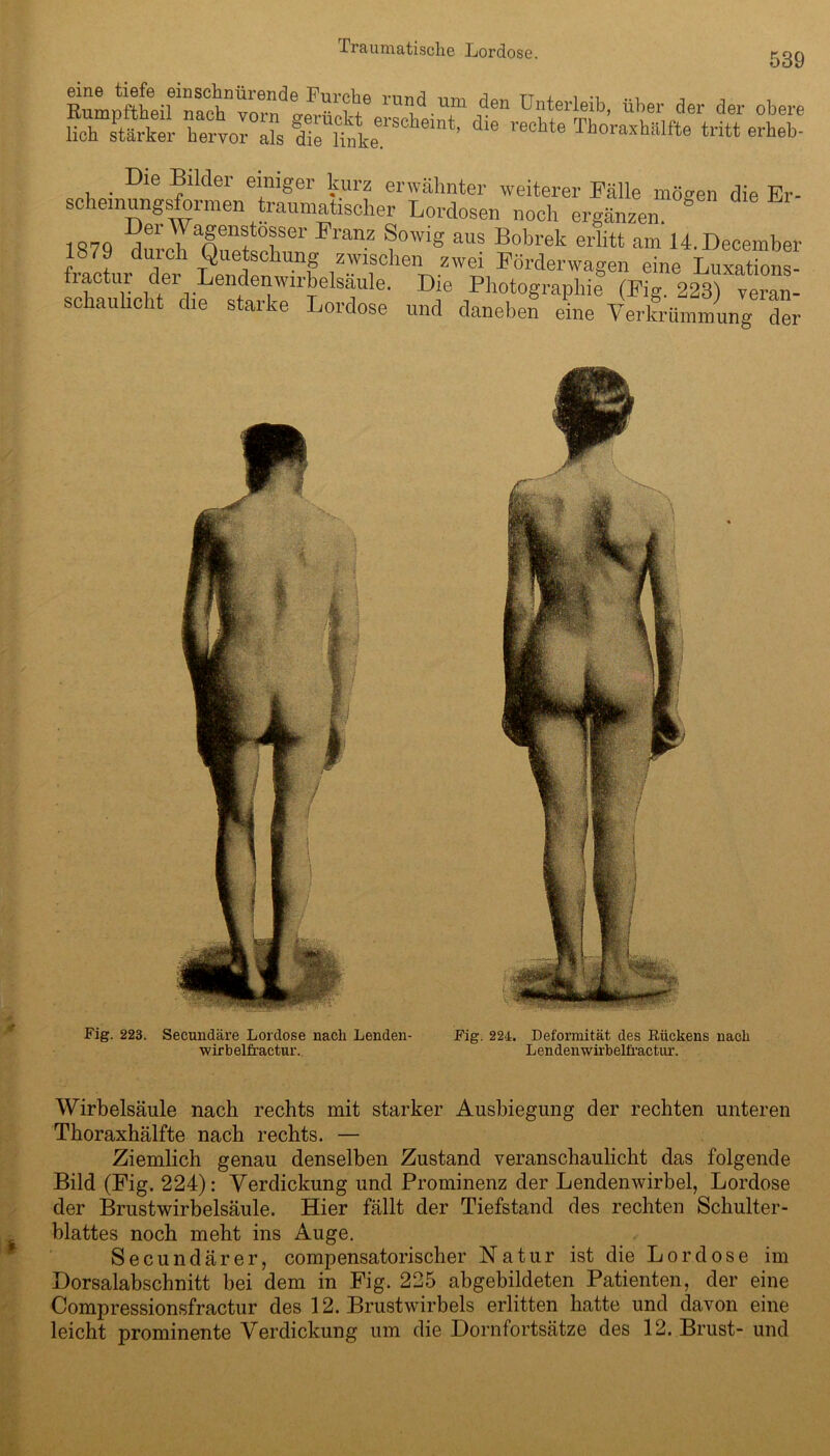 539 eine tiefe einschnürende Furche rund um den Unterleib über der der obere lieh Stärker WvoFS ^ r6Chte Tho’raxhftlfte tritt eri>eb- Die Bilder einiger kurz erwähnter weiterer Fälle mögen die Er- schemungsformen traumatischer Lordosen noch ergänzen. 1070 i61 YaSenf°fer Franz Sowig aus Bobrek erlitt am 14. Decemher 1879 durch Quetschung zwischen zwei Förderwagen eine Luxations- fractur der Lendenwn-helsäule. Die Photographie (Fig. 223) verS- schauhcht die starke Lordose und daneben eine Verkrümmung der Fig. 223. Fig. 224. Deformität des Rückens nach Lendenwirbelfractur. Secundäre Lordose nach Lenden- wirbelfractur. Wirbelsäule nach rechts mit starker Ausbiegung der rechten unteren Thoraxhälfte nach rechts. — Ziemlich genau denselben Zustand veranschaulicht das folgende Bild (Fig. 224): Verdickung und Prominenz der Lendenwirbel, Lordose der Brustwirbelsäule. Hier fällt der Tiefstand des rechten Schulter- blattes noch meht ins Auge. Secundärer, compensatorischer Natur ist die Lordose im Dorsalabschnitt bei dem in Fig. 225 abgebildeten Patienten, der eine Compressionsfractur des 12. Brustwirbels erlitten hatte und davon eine leicht prominente Verdickung um die Dornfortsätze des 12. Brust- und
