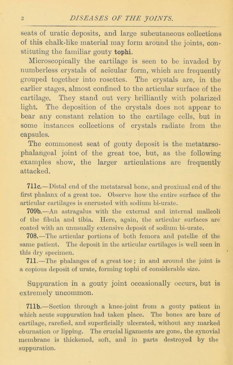 seats of uratic deposits, and large subcutaneous collections of this chalk-like material may form around the joints, con- stituting the familiar gouty tophi. Microscopically the cartilage is seen to be invaded by numberless crystals of acicular form, which are frequently grouped together into rosettes. The crystals are, in the earlier stages, almost confined to the articular surface of the cartilage. They stand out very brilliantly with polarized light. The deposition of the crystals does not appear to bear any constant relation to the cartilage cells, but in some instances collections of crystals radiate from the capsules. The commonest seat of gouty deposit is the metatarso- phalangeal joint of the great toe, but, as the following examples show, the larger articulations are frequently attacked. 711c.—Distal end of the metatarsal bone, and proximal end of the first phalanx of a great toe. Observe how the entire surface of the articular cartilages is encrusted with sodium bi-urate. 709b.—An astragalus with the external and internal malleoli of the fibula and tibia. Here, again, the articular surfaces are coated with an unusually extensive deposit of sodium bi-urate. 708.—The articular portions of both femora and patellte of the same patient. The deposit in the articular cartilages is well seen in this dry specimen. 711.—The phalanges of a great toe ; in and around the joint is a copious deposit of urate, forming tophi of considerable size. Suppuration in a gouty joint occasionally occurs, but is extremely uncommon. 711b.—Section through a knee-joint from a gouty patient in which acute suppuration had taken place. The bones are bare of cartilage, rarefied, and superficially ulcerated, without any marked eburnation or lipping. The crucial ligaments are gone, the synovial membrane is thickened, soft, and in parts destroyed by the suppuration.