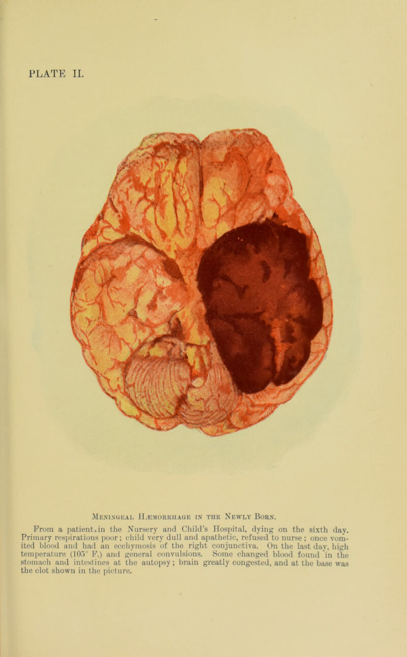 PLATE II. Meningeal 1I.^:mork,uage in the Newly Born. From a patient.in the Nursery and Child’s Hospital, dying on the sixth day. Primary respirations poor; child very dull and apathetic, refused to nurse ; once vom- ited blood and had an eccliymosis of the riglit conjunctiva. On the last day, high temperature (10.)° F.) and general convulsions. Some changed blood found in the stomach and intestines at the autopsy; brain greatly congested, and at the base was the clot shown in the picture.