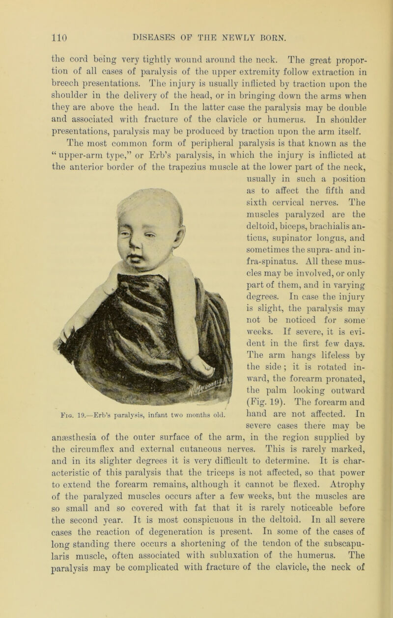 the cord being very tightly wound around tlie neck. The great propor- tion of all cases of paralysis of the upper extremity follow extraction in breech presentations. The injury is usually inllicted by traction upon the shoulder in the delivery of the head, or in bringing down the arms when they are above the head. In the latter case the paralysis may be double and associated with fracture of the clavicle or humerus. In shoulder presentations, paralysis may be produced by traction upon the arm itself. The most common form of peripheral paralysis is that known as the “upper-arm type,” or Erb’s paralysis, in which the injury is inflicted at the anterior border of the trapezius muscle at the lower part of the neck, usually in such a j^osition as to affect the fifth and sixth cervical nerves. The muscles paralyzed are the deltoid, biceps, brachialis an- ticus, supinator longus, and sometimes the supra- and in- fra-spinatus. All these mus- cles may be involved, or only part of them, and in varying degrees. In case the injury is slight, the paralysis may not be noticed for some weeks. If severe, it is evi- dent in the first few davs. The arm hangs lifeless by the side; it is rotated in- ward, the forearm pronated, the palm looking outward (Fig. 19). The forearm and hand are not affected. In severe cases there may be anaesthesia of the outer surface of the arm, in the region supplied by the circumflex and external cutaneous nerves. This is rarely marked, and in its slighter degrees it is very difficult to determine. It is char- acteristic of this paralysis that the triceps is not affected, so that power to extend the forearm remains, although it cannot be flexed. Atrophy of the paralyzed muscles occurs after a few weeks, but the muscles are so small and so covered with fat that it is rarely noticeable before the second year. It is most conspicuous in the deltoid. In all severe cases the reaction of degeneration is present. In some of the cases of long standing there occurs a shortening of the tendon of the subscapu- laris muscle, often associated with subluxation of the humerus. The paralysis may be complicated with fracture of the clavicle, the neck of U Fig. 19.—Erb’a paralysis, infant two months old.