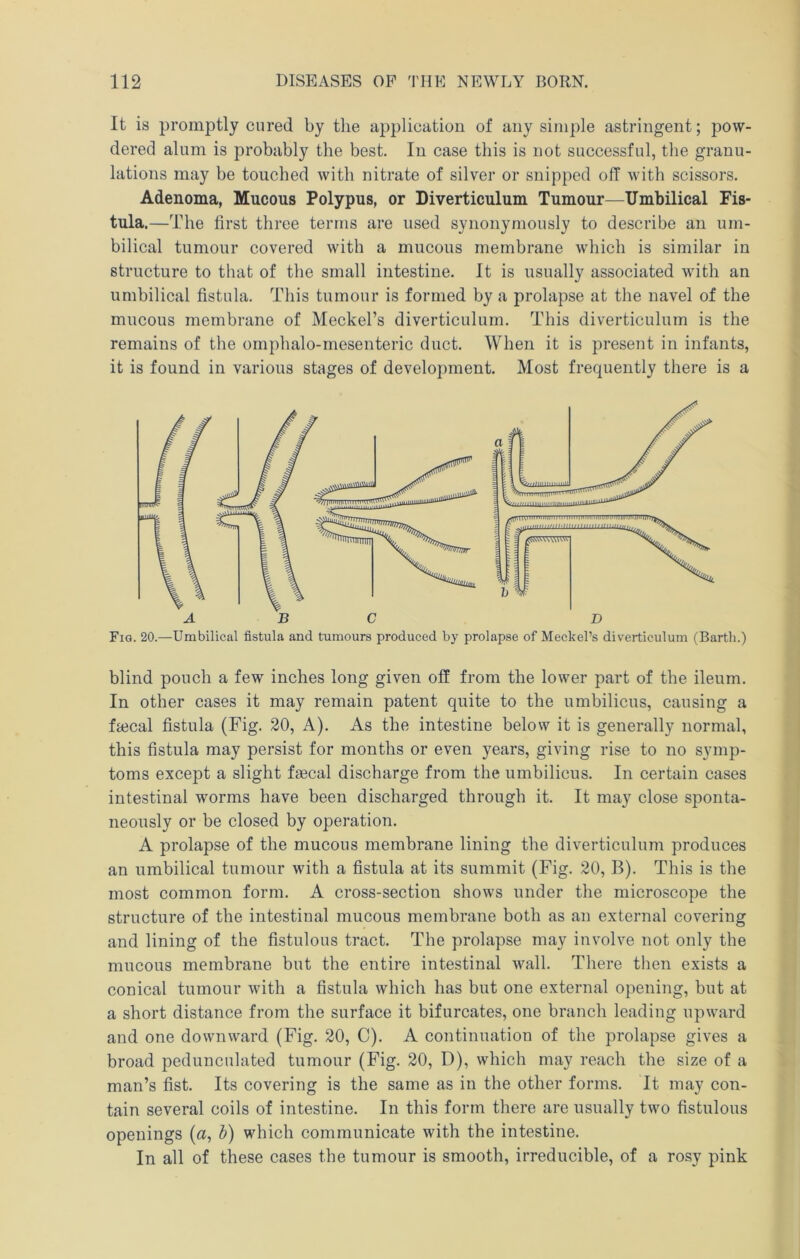 It is promptly cured by the application of any simple astringent; pow- dered alum is probably the best. In case this is not successful, the granu- lations may be touched with nitrate of silver or snipped off with scissors. Adenoma, Mucous Polypus, or Diverticulum Tumour—Umbilical Fis- tula.—The first three terms are used synonymously to describe an um- bilical tumour covered with a mucous membrane which is similar in structure to that of the small intestine. It is usually associated with an umbilical fistula. This tumour is formed by a prolapse at the navel of the mucous membrane of Meckel’s diverticulum. This diverticulum is the remains of the ornphalo-mesenteric duct. When it is present in infants, it is found in various stages of development. Most frequently there is a Fig. 20.—Umbilical fistula and tumours produced by prolapse of Meckel’s diverticulum (Barth.) blind pouch a few inches long given off from the lower part of the ileum. In other cases it may remain patent quite to the umbilicus, causing a ffeecal fistula (Fig. 20, A). As the intestine below it is generally normal, this fistula may persist for months or even years, giving rise to no symp- toms except a slight fgecal discharge from the umbilicus. In certain cases intestinal worms have been discharged through it. It may close sponta- neously or be closed by operation. A prolapse of the mucous membrane lining the diverticulum produces an umbilical tumour with a fistula at its summit (Fig. 20, B). This is the most common form. A cross-section shows under the microscope the structure of the intestinal mucous membrane both as an external covering and lining of the fistulous tract. The prolapse may involve not only the mucous membrane but the entire intestinal wall. There then exists a conical tumour with a fistula which has but one external opening, but at a short distance from the surface it bifurcates, one branch leading upward and one downward (Fig. 20, C). A continuation of the prolapse gives a broad pedunculated tumour (Fig. 20, D), which may reach the size of a man’s fist. Its covering is the same as in the other forms. It may con- tain several coils of intestine. In this form there are usually two fistulous openings (a, h) which communicate with the intestine. In all of these cases the tumour is smooth, irreducible, of a rosy pink