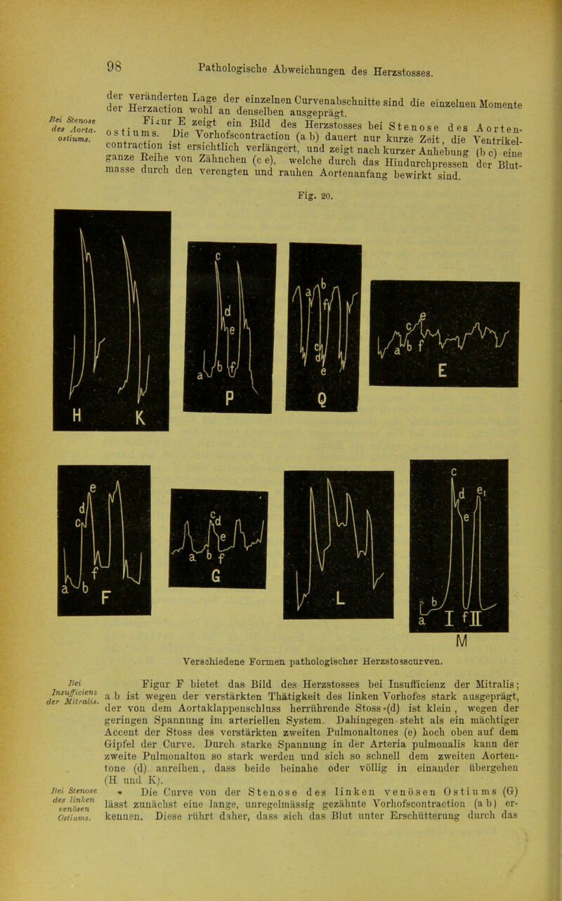 flei Stenose des Aorta- ostiums. & die o s t i u m s. Pie Vo^.ofsconüStiot(a^)1 ‘dauerf nur kurze“ Zeit, 'die' Yentrikeb contiaction ist ersichtlich verlängert, und zeigt nach kurzer Anhebung (b c) eine ^anze Reihe von Zalinchen (c e), welche durch das Hiudurchpressen der Blut- masse durch den verengten und rauhen Aortenanfang bewirkt sind. Fig. 20. Verschiedene Formen pathologischer Herzstosscurven. Hei Insufficicnz der Mitralis. Jlei Stenose des linken venHsen Ostiums. Figur F bietet das Bild des Herzstosses bei Insufficienz der Mitralis; a b ist wegen der verstärkten Thätigkeit des linken Vorhofes stark ausgeprägt, der von dem Aortaklappenschluss herrührende Stoss-(d) ist klein, wegen der geringen Spannung im arteriellen System. Dahingegen steht als ein mächtiger Accent der Stoss des verstärkten zweiten Pulmonaltones (e) hoch oben auf dem Gipfel der Curve. Durch starke Spannung in der Arteria pulmonalis kann der zweite Pulmonalton so stark werden und sich so schnell dem zweiten Aorten- tone (d) anreihen, dass beide beinahe oder völlig in einander übergehen (H und Kj. » Die Curve von der Stenose des linken venösen Ostiums (G) lässt zunächst eine lange, unregelmässig gezähnte Vorhofscontraction (ab) er- kennen. Diese rührt daher, dass sich das Blut unter Erschütterung durch das