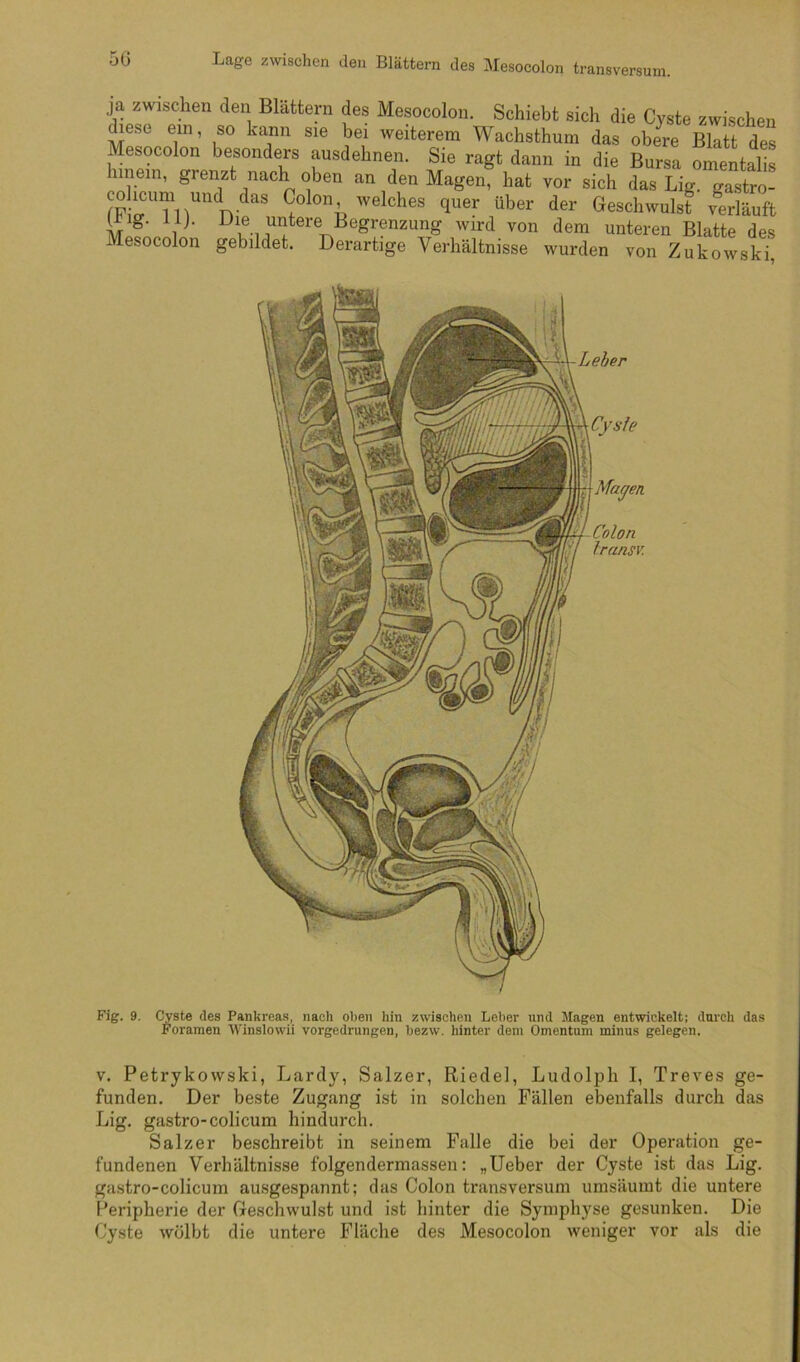 5G Lage zwischen den Blättern des Mesocolon transversum. ja zwischen den Blättern des Mesocolon. Schiebt sich die Cyste zwischen diese ein, so kann sie bei weiterem Wachsthum das obere Blatt des esocolon besonders ausdehnen. Sie ragt dann in die Bursa omentalis hinein, grenzt nach oben an den Magen, hat vor sich das Lig. gastro- F n ' '^«Iches quer über der Geschwulst v^läuft ^ig. 11). Die untere Begrenzung wird von dem unteren Blatte des Mesocolon gebildet. Derartige Verhältnisse wurden von Zukowski, Leber Cysie Mayen Colon Iransv. Fig. 9. Cyste des Pankreas, nach oben hin zwischen Leber und Magen entwickelt: durch das Foramen Winslowii vorgedrungen, bezw. hinter dem Omentum minus gelegen. V. Petrykowski, Lardy, Salzer, Riedel, Ludolph I, Treves ge- funden. Der beste Zugang ist in solchen Fällen ebenfalls durch das Lig. gastro-colicum hindurch. Salzer beschreibt in seinem Falle die bei der Operation ge- fundenen Verhältnisse folgendermassen: „lieber der Cyste ist das Lig. gastro-colicum ausgespannt; das Colon transversum umsäumt die untere Peripherie der Geschwulst und ist hinter die Symphyse gesunken. Die Cyste wölbt die untere Fläche des Mesocolon weniger vor als die
