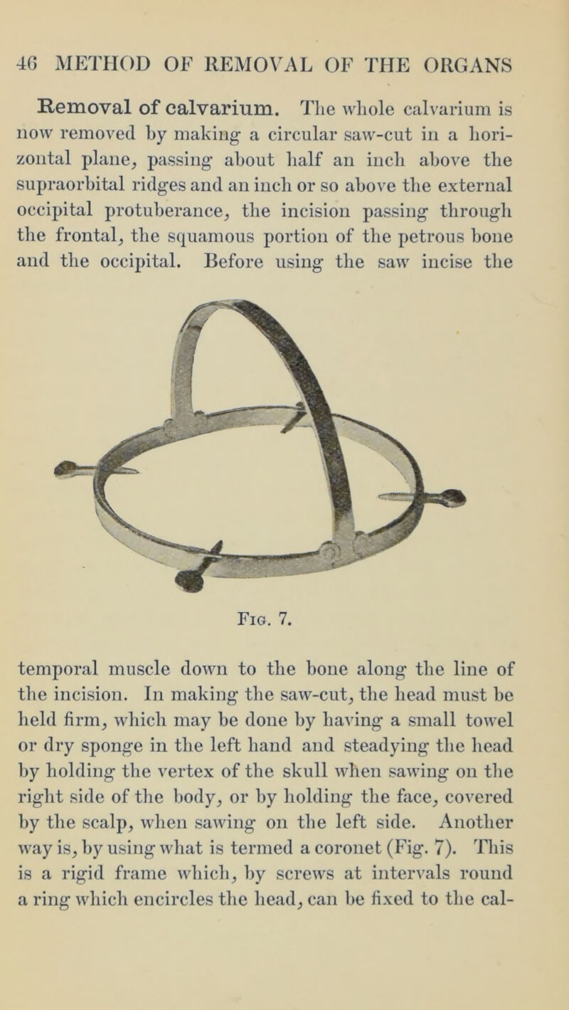 Removal of calvarium. The whole calvarium is now removed by making a circular saw-cut in a hori- zontal plane^ passing about half an inch above the supraorbital ridges and an inch or so above the external occipital protuberance^ the incision passing through the frontal^ the squamous portion of the petrous hone and the occipital. Before using the saw incise the Fig. 7. temporal muscle doivn to the bone along the line of the incision. In making the saw-cut^ the head must be held firm, which may be done by having a small towel or dry sponge in the left hand and steadying the head by holding the vertex of the skull when sawing on the right side of the body, or by holding the face, covered by the scalp, when sawing on the left side. Another way is, by using what is termed a coronet (Fig. 7). This is a rigid frame which, by screws at intervals round a ring which encircles the head, can be fixed to the cal-