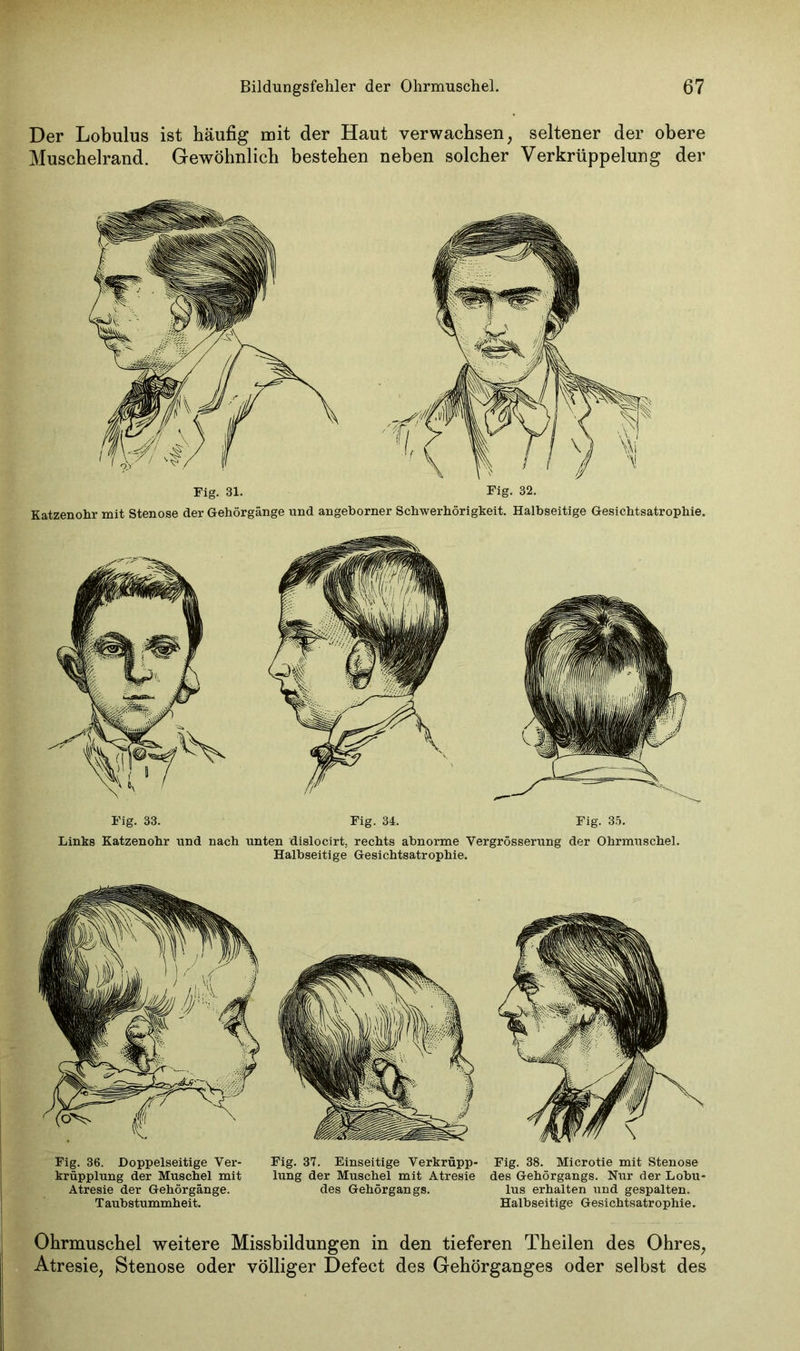 Der Lobulus ist häufig mit der Haut verwachsen; seltener der obere Muschelrand. Gewöhnlich bestehen neben solcher Verkrüppelung der Fig. 33. Fig. 34. Fig. 35. Links Katzenohr und nach unten dislocirt. rechts abnorme Vergrösserung der Ohrmuschel. Halbseitige Gesichtsatrophie. Fig. 36. Doppelseitige Ver- Fig. 37. Einseitige Verkrüpp- Fig. 38. Microtie mit Stenose krüpplung der Muschel mit lung der Muschel mit Atresie des Gehörgangs. Nur der Lobu- Atresie der Gehörgänge. des Gehörgangs. lus erhalten und gespalten. Taubstummheit. Halbseitige Gesichtsatrophie. Ohrmuschel weitere Missbildungen in den tieferen Theilen des Ohres, Atresie, Stenose oder völliger Defect des Gehörganges oder selbst des