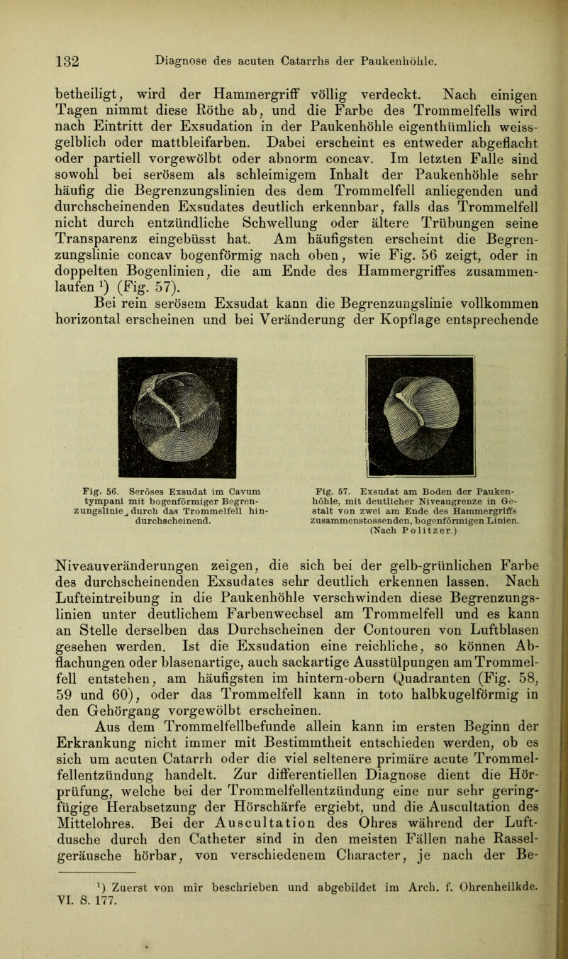 betheiligt, wird der Hammergriff völlig verdeckt. Nach einigen Tagen nimmt diese Röthe ab, und die Farbe des Trommelfells wird nach Eintritt der Exsudation in der Paukenhöhle eigentümlich weiss- gelblich oder mattbleifarben. Dabei erscheint es entweder abgeflacht oder partiell vorgewölbt oder abnorm concav. Im letzten Falle sind sowohl bei serösem als schleimigem Inhalt der Paukenhöhle sehr häufig die Begrenzungslinien des dem Trommelfell anliegenden und durchscheinenden Exsudates deutlich erkennbar, falls das Trommelfell nicht durch entzündliche Schwellung oder ältere Trübungen seine Transparenz eingebüsst hat. Am häufigsten erscheint die Begren- zungslinie concav bogenförmig nach oben, wie Fig. 56 zeigt, oder in doppelten Bogenlinien, die am Ende des Hammergriffes zusammen- laufen x) (Fig. 57). Bei rein serösem Exsudat kann die Begrenzungslinie vollkommen horizontal erscheinen und bei Veränderung der Kopflage entsprechende Fig. 56. Seröses Exsudat im Cavum tympani mit bogenförmiger Begren- zungslinie durch das Trommelfell hin- durchscheinend. Fig. 57. Exsudat am Boden der Pauken- höhle, mit deutlicher Niveaugrenze in Ge- stalt von zwei am Ende des Hammergriffs zusammenstossenden, bogenförmigen Linien. (Nach Politzer.) Niveauveränderungen zeigen, die sich bei der gelb-grünlichen Farbe des durchscheinenden Exsudates sehr deutlich erkennen lassen. Nach Lufteintreibung in die Paukenhöhle verschwinden diese Begrenzungs- linien unter deutlichem Farbenwechsel am Trommelfell und es kann an Stelle derselben das Durchscheinen der Contouren von Luftblasen gesehen werden. Ist die Exsudation eine reichliche, so können Ab- flachungen oder blasenartige, auch sackartige Ausstülpungen am Trommel- fell entstehen, am häufigsten im hintern-obern Quadranten (Fig. 58, 59 und 60), oder das Trommelfell kann in toto halbkugelförmig in den Gehörgang vorgewölbt erscheinen. Aus dem Trommelfellbefunde allein kann im ersten Beginn der Erkrankung nicht immer mit Bestimmtheit entschieden werden, ob es sich um acuten Catarrh oder die viel seltenere primäre acute Trommel- fellentzündung handelt. Zur differentiellen Diagnose dient die Hör- prüfung, welche bei der Trommelfellentzündung eine nur sehr gering- fügige Herabsetzung der Hörschärfe ergiebt, und die Auscultation des Mittelohres. Bei der Auscultation des Ohres während der Luft- dusche durch den Catheter sind in den meisten Fällen nahe Rassel- geräusche hörbar, von verschiedenem Character, je nach der Be- x) Zuerst von mir beschrieben und abgebildet im Arch. f. Ohrenheilkde. VI. S. 177.
