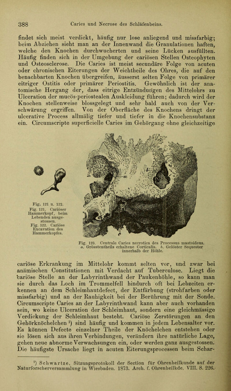 findet sich meist verdickt, häufig nur lose anliegend und missfarbig; beim Abziehen sieht man an der Innenwand die Granulationen haften, welche den Knochen durchwucherten und seine Lücken ausfüllten. Häufig finden sich in der Umgebung der cariösen Stellen Osteophyten und Osteosclerose. Die Caries ist meist secundäre Folge von acuten oder chronischen Eiterungen der Weichtheile des Ohres, die auf den benachbarten Knochen übergreifen, äusserst selten Folge von primärer eitriger Ostitis oder primärer Periostitis. Gewöhnlich ist der ana- tomische Hergang der, dass eitrige Entzündungen des Mittelohrs zu Ulceration der mucös-periostealen Auskleidung führen; dadurch wird der Knochen stellenweise blossgelegt und sehr bald auch von der Ver- schwärung ergriffen. Von der Oberfläche des Knochens dringt der ulcerative Process allmälig tiefer und tiefer in die Knochensubstanz ein. Circumscripte superficielle Caries im Gehörgang ohne gleichzeitige Fig. 121 u. 122. Fig. 121. Cariöser Hammerkopf, beim Lebenden ausge- stossen. Fig. 122. Cariöse Excavation des Hammerkopfes. Fig. 123. Centrale Caries necrotica des Processus mastoideus. a. Grösstentheils erhaltene Corticalis. b. Gelöster Sequester innerhalb der Höhle. cariöse Erkrankung im Mittelohr kommt selten vor, und zwar bei anämischen Constitutionen mit Verdacht auf Tubereulose. Liegt die ‘cariöse Stelle an der Labyrinthwand der Paukenhöhle, so kann man sie durch das Loch im Trommelfell hindurch oft bei Lebzeiten er- kennen an dem Schleimhautdefect, der Entfärbung (strohfarben oder missfarbig) und an der Rauhigkeit bei der Berührung mit der Sonde. Circumscripte Caries an der Labyrinthwand kann aber auch vorhanden sein, wo keine Ulceration der Schleimhaut, sondern eine gleichmässige Verdickung der Schleimhaut besteht. Cariöse Zerstörungen an den Gehörknöchelchen *) sind häufig und kommen in jedem Lebensalter vor. Es können Defecte einzelner Theile der Knöchelchen entstehen oder sie lösen sich aus ihren Verbindungen, verändern ihre natürliche Lage, gehen neue abnorme Verwachsungen ein, oder werden ganz ausgestossen. Die häufigste Ursache liegt in acuten Eiterungsprocessen beim Schar- *) Schwartze, Sitzungsprotokoll der Section für Ohrenheilkunde auf der Naturforscherversammlung in Wiesbaden. 1873. Arch. f. Ohrenheilkde. VIII. S. 226.-