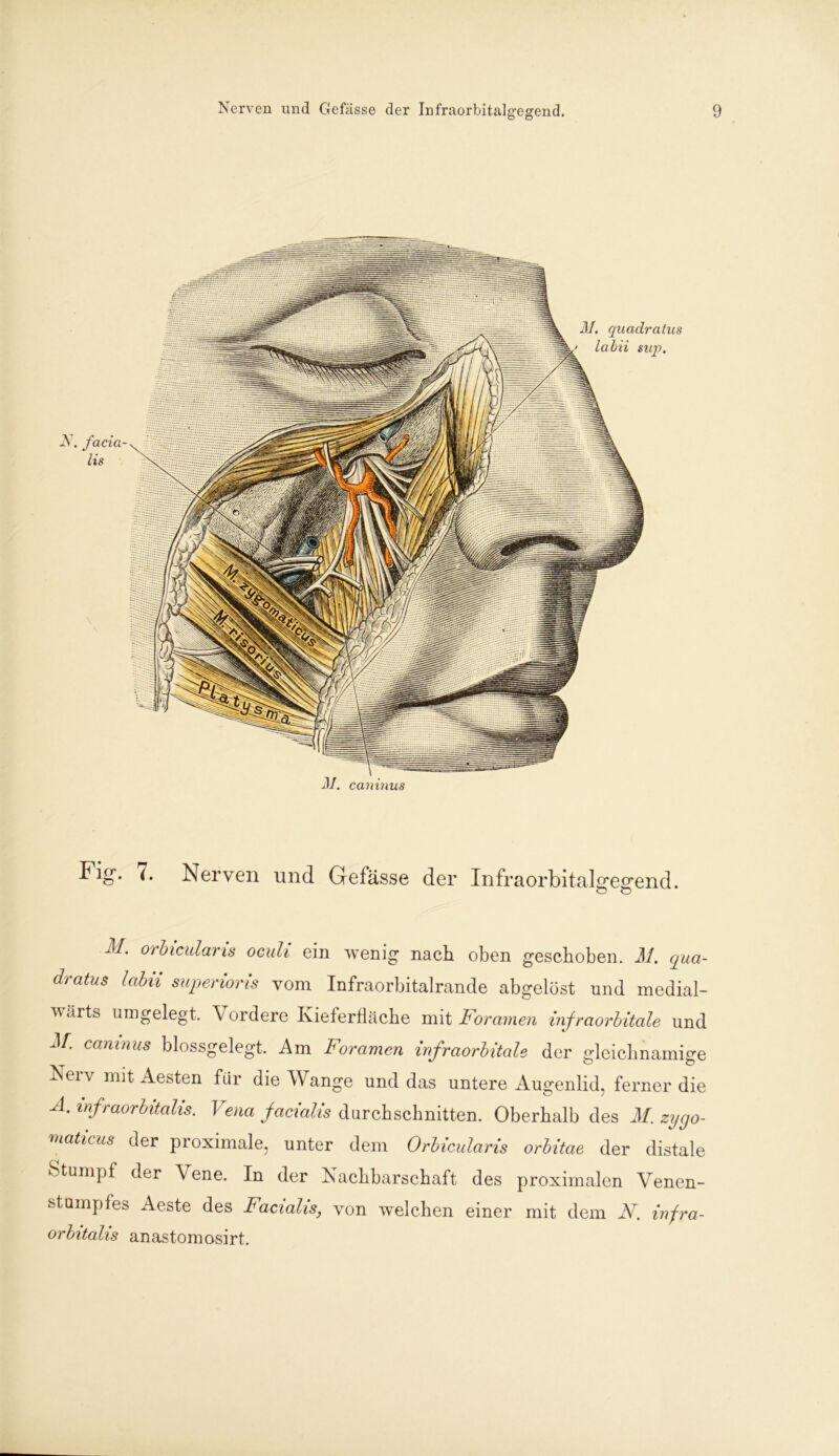Fig*. 7. Nerven und Gelasse der Infraorbitalgeg'end. O ö M. orbiculams ocuh ein wenig nach oben geschoben. M. qua- dratus labii superioris vom Infraorbitalrande abgelöst und medial- wärts umgelegt. Vordere Kieferfläche mit Foramen infraorbitale und caninus blossgelegt. Am Foramen infraorbitale der gleichnamige Neiv mit Aesten für die Wange und das untere Augenlid, ferner die A. infraorbitahs. Vena facialis durchschnitten. Oberhalb des M. zygo- maticus der proximale, unter dem Orbicularis orbitae der distale Stumpf der Vene. In der Nachbarschaft des proximalen Venen- stumpfes Aeste des Facialis, von welchen einer mit dem N. infra- orbitahs anastomosirt.