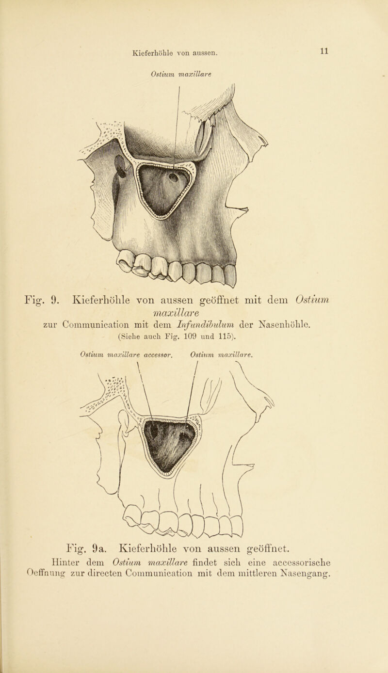 Kieferhöhle von aussen. Osthim maxillare Fig. 0. Kieferhöhle von aussen geöffnet mit dem Ostium maxillare zur Communication mit dem Infundibulum der Nasenhöhle. (Siehe auch Fig-. 109 und 115). Ostium maxillare accessor. Ostium maxillare. Fig. 9a. Kieferhöhle von aussen geöffnet. Hinter dem Ostium maxillare findet sich eine accessorische Oeffnung zur directen Communication mit dem mittleren Nasengang.