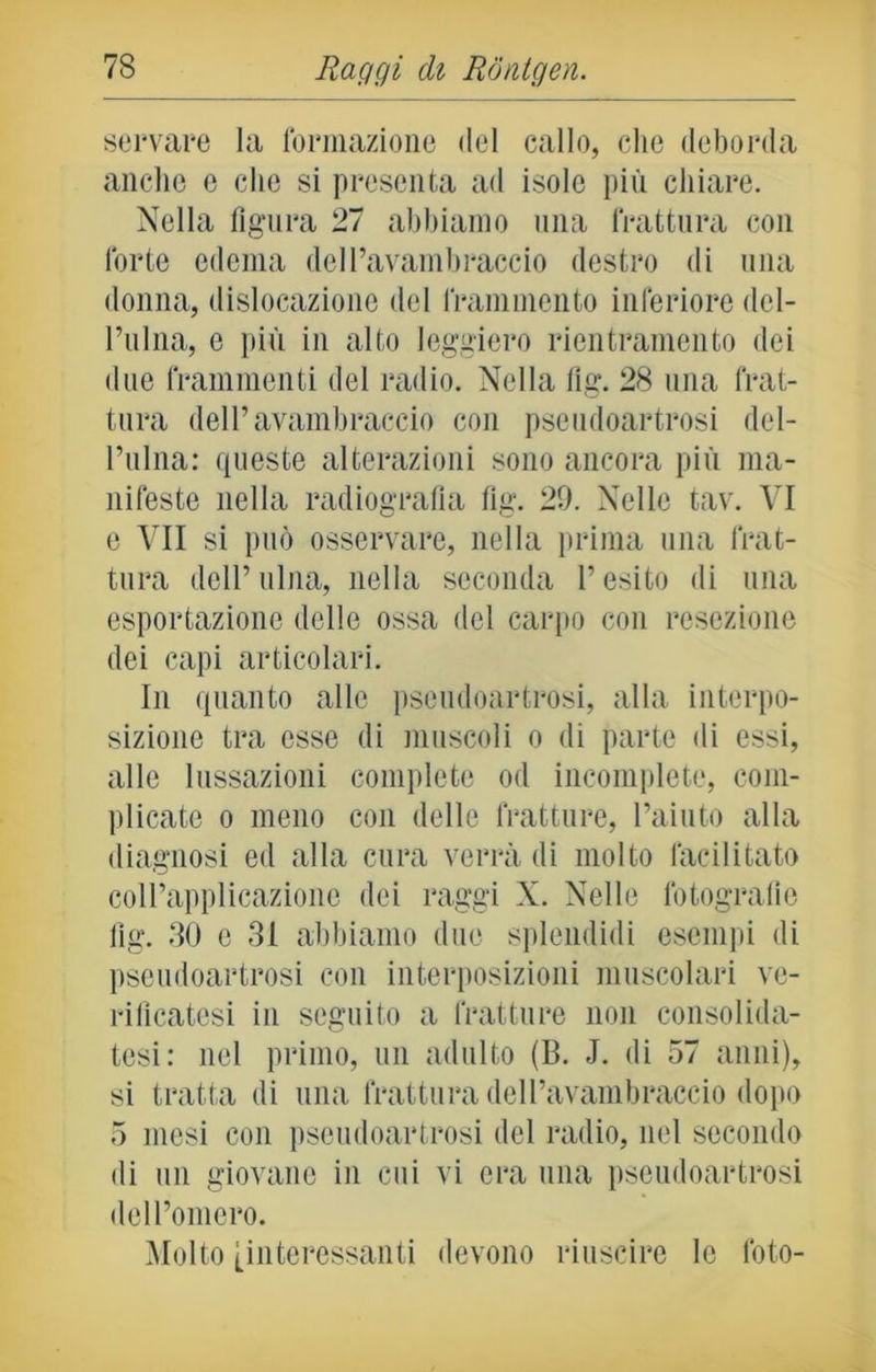 servare la formazione del callo, che deborda anche c che si presenta ad isolo più chiare. Nella figura 27 abbiamo una frattura con forte edema dell’avambraccio destro di una donna, dislocazione del frammento inferiore del- l’ulna, e più in alto leggiero ricntramento dei due frammenti del radio. Nella fig. 28 una frat- tura dell’avambraccio con pseudoartrosi del- l’ulna: queste alterazioni sono ancora più ma- nifeste nella radiografia fig. 29. Nelle tav. VI e VII si può osservare, nella prima una frat- tura dell’ulna, nella seconda l’esito di una esportazione delle ossa del carpo con resezione dei capi articolari. In quanto alle pseudoartrosi, alla interpo- sizione tra esse di muscoli o di parte di essi, alle lussazioni complete od incomplete, com- plicate o meno con delle fratture, l’aiuto alla diagnosi ed alla cura verrà di molto facilitato coll’applicazione dei raggi X. Nelle fotografie fig. 30 e 31 abbiamo due splendidi esentili di pseudoartrosi con interposizioni muscolari ve- rificatesi in seguito a fratture non consolida- tesi: nel primo, un adulto (B. J. di 57 anni), si tratta di una frattura dell’avambraccio dopo 5 mesi con pseudoartrosi del radio, nel secondo di un giovane in cui vi era una pseudoartrosi dell’omero. Molto [interessanti devono riuscire le foto-