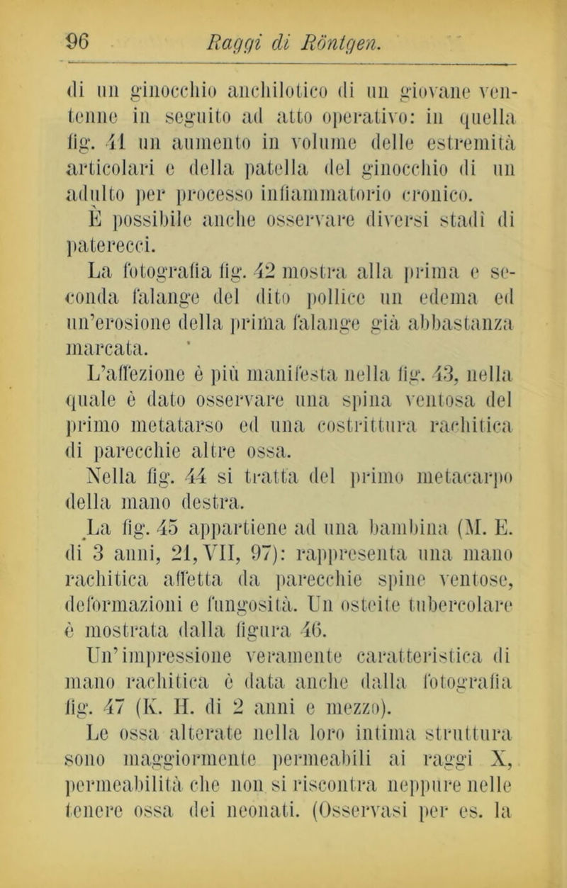 di un ginocchio ancliilotico di un giovane ven- tenne in seguito ad atto operativo: in quella tig. il un aumento in volume delle estremità articolari e della patella del ginocchio di un adulto per processo infiammatorio cronico. È possibile anche osservare diversi stadi di paterecci. La fotografia fig. 42 mostra alla prima e se- conda falange del dito pollice un edema ed un’erosione della prima falange già abbastanza marcata. L’affezione è più manifesta nella fig. 43, nella quale è dato osservare una spina ventosa del primo metatarso ed una costrittura rachitica di parecchie altre ossa. Nella fig. 44 si tratta del primo metacarpo della mano destra. La fig. 45 appartiene ad una bambina (M. E. di 3 anni, 21, VII, 97): rappresenta una mano rachitica affetta da parecchie spine ventose, deformazioni e fungosità. Un osteite tubercolare è mostrata dalla figura 46. Un’impressione veramente caratteristica di mano rachitica è data anche dalla fotografia fig. 47 (Iv. IL di 2 anni e mezzo). Le ossa alterate nella loro intima struttura sono maggiormente permeabili ai raggi X, permeabilità che non si riscontra neppure nelle tenere ossa dei neonati. (Osservasi per es. la