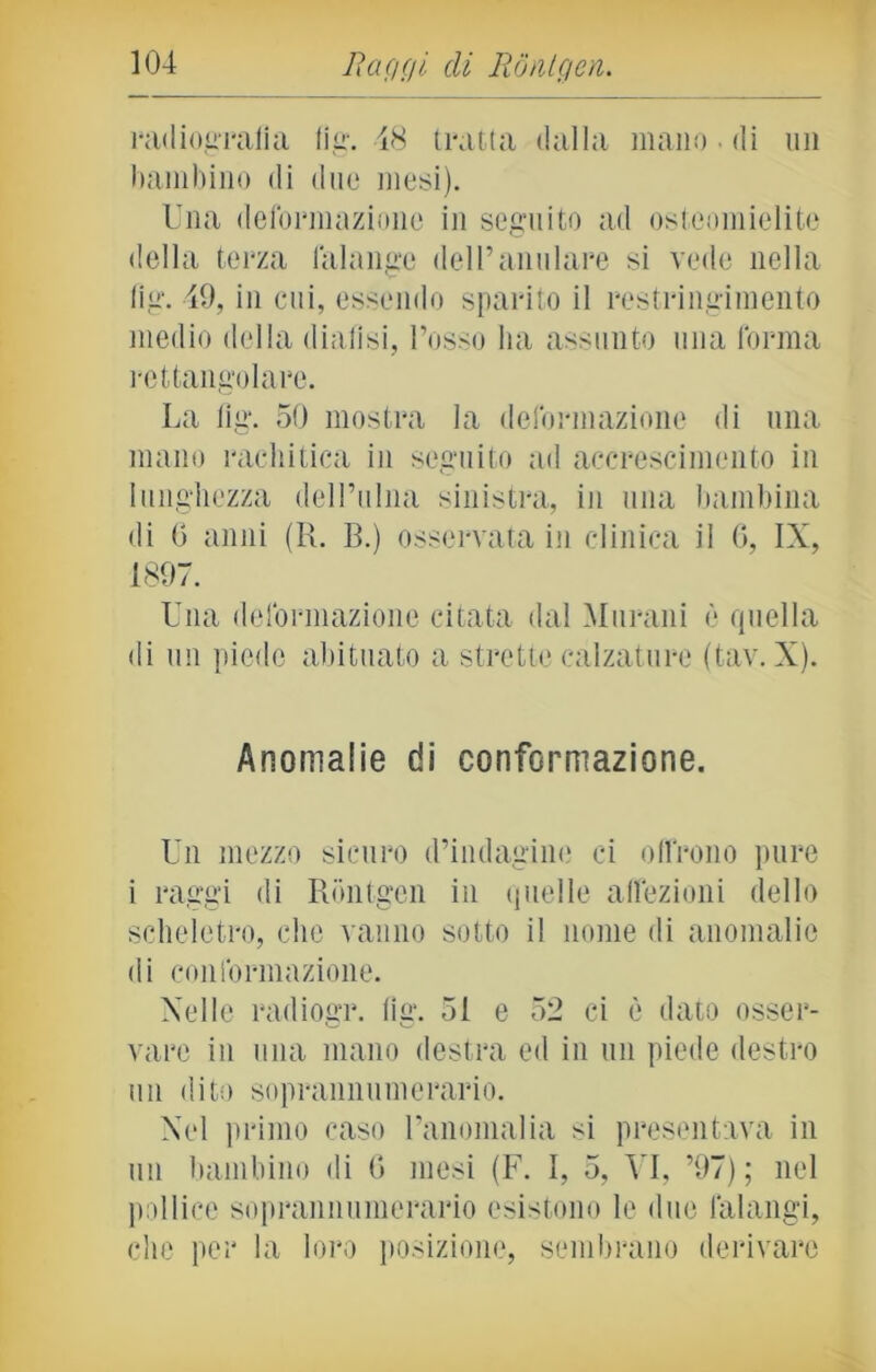 radiografia fig. 48 tratta dalla mano ■ di un bambino di due mesi). Una deformazione iti seguito ad osteomielite della terza falange dell’anulare si vede nella lig. 49, in cui, essendo sparito il restringimento medio della dialisi, l’osso ha assunto una forma rettangolare. La fig. 50 mostra la deformazione di una mano rachitica in seguito ad accrescimento in lunghezza dell’ulna sinistra, in una bambina di 0 anni (R. B.) osservata in clinica il 6, IX, 1897. Una deformazione citata dal Murarli è quella di un piede abituato a strette calzature (tav. X). Anomalie di conformazione. Un mezzo sicuro d’indagine ci offrono pure i raggi di Rontgen in quelle affezioni dello scheletro, che vanno sotto il nome di anomalie di conformazione. Nelle radiogr. fig. 51 e 52 ci è dato osser- vare in una mano destra ed in un piede destro un dito soprannumerario. Nel primo caso l’anomalia si presentava in un bambino di G mesi (F. 1, 5, VI, ’97) ; nel pollice soprannumerario esistono le due falangi, che per la loro posizione, sembrano derivare