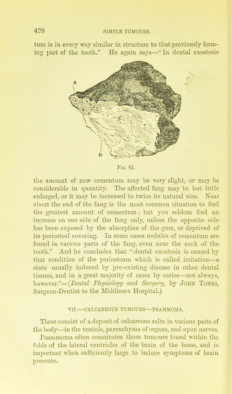 turn is in every way similar in structure to that previously form- ing part of the tooth.” He again says—“ In dental exostosis the amount of new cementum may be very slight, or may be considerable in quantity. The affected fang may be but little enlarged, or it may be increased to twice its natural size. Hear about the end of the fang is the most common situation to find the greatest amount of cementum; but you seldom find an increase on one side of the fang only, unless the opposite side has been exposed by the absorption of the gum, or deprived of its periosteal covering. In some cases nodules of cementum are found in various parts of the fang, even near the neck of the tooth.” And he concludes that “ dental exostosis is caused by that condition of the periosteum which, is called irritation—a state usually induced by pre-existing disease in other dental tissues, and in a great majority of cases by caries—not always, however.”—{Dental Physiology and Surgery, by John Tomes, Surgeon-Dentist to the Middlesex Hospital.) These consist of a deposit of calcareous salts in various parts of the body—in the testicle, parenchyma of organs, and upon nerves. Psammoma often constitutes those tumours found within the folds of the lateral ventricles of the brain of the horse, and is important when sufficiently large to induce symptoms of brain pressure. Tig. 85. VII.—CALCAREOUS TUMOURS—PSAMMOMA.