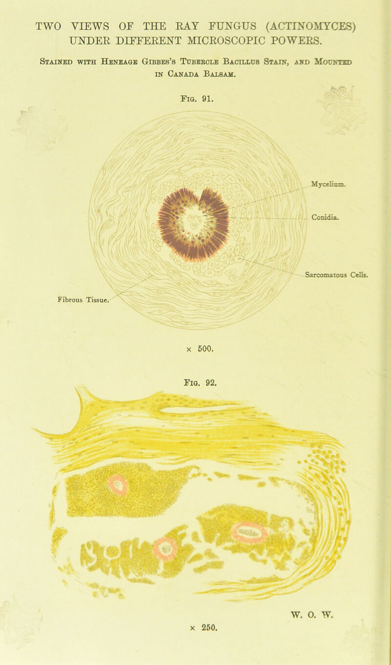 TWO VIEWS OF THE RAY FUNGUS (ACTINOMYCES) UNDER DIFFERENT MICROSCOPIC POWERS. Stained with Heneage Gibbes’s Tubebcle Bacillus Stain, and Mounted in Canada Balsam. Fig. 91. x 500. Fig. 92. • awl * **VrS^ a vaL. — a SSb i-' v *• 1 V V\\ »tih\ tVI in Oil) ID/ ^ \i/l IJH 9s / 4 !/ 2/ A Jwf J'J*sLr <Ss w. o. w. x 250,