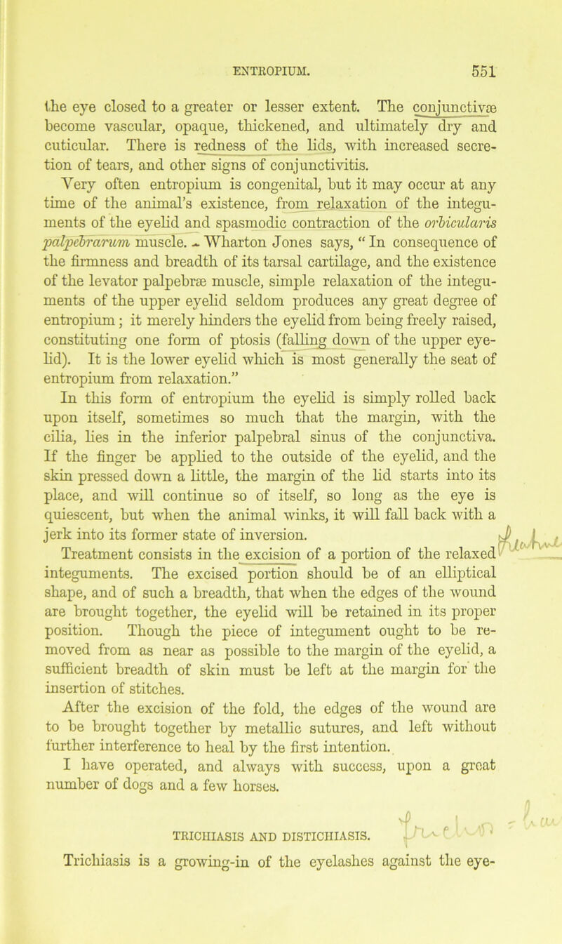 the eye closed to a greater or lesser extent. The conjunctivae become vascular, opaque, thickened, and ultimately dry and cuticular. There is redness of the lids, with increased secre- tion of tears, and other signs of conjunctivitis. Yery often entropium is congenital, hut it may occur at any time of the animal’s existence, from relaxation of the integu- ments of the eyelid and spasmodic contraction of the orbicularis palpebrarum muscle. - Wharton Jones says, “ In consequence of the firmness and breadth of its tarsal cartilage, and the existence of the levator palpebrte muscle, simple relaxation of the integu- ments of the upper eyelid seldom produces any great degree of entropium; it merely hinders the eyelid from being freely raised, constituting one form of ptosis (falling down of the upper eye- lid). It is the lower eyelid which is most generally the seat of entropium from relaxation.” In this form of entropium the eyelid is simply rolled back upon itself, sometimes so much that the margin, with the cilia, lies in the inferior palpebral sinus of the conjunctiva. If the finger be applied to the outside of the eyelid, and the skin pressed down a little, the margin of the lid starts into its place, and will continue so of itself, so long as the eye is quiescent, but when the animal winks, it will fall back with a jerk into its former state of inversion. Treatment consists in the excision of a portion of the relaxed integuments. The excised portion should be of an elliptical shape, and of such a breadth, that when the edges of the wound are brought together, the eyelid will be retained in its proper position. Though the piece of integument ought to be re- moved from as near as possible to the margin of the eyelid, a sufficient breadth of skin must be left at the margin for' the insertion of stitches. After the excision of the fold, the edges of the wound are to be brought together by metallic sutures, and left without further interference to heal by the first intention. I have operated, and always with success, upon a great number of dogs and a few horses. Trichiasis is a growing-in of the eyelashes against the eye- TEICIIIASIS AND DISTICHIASIS.