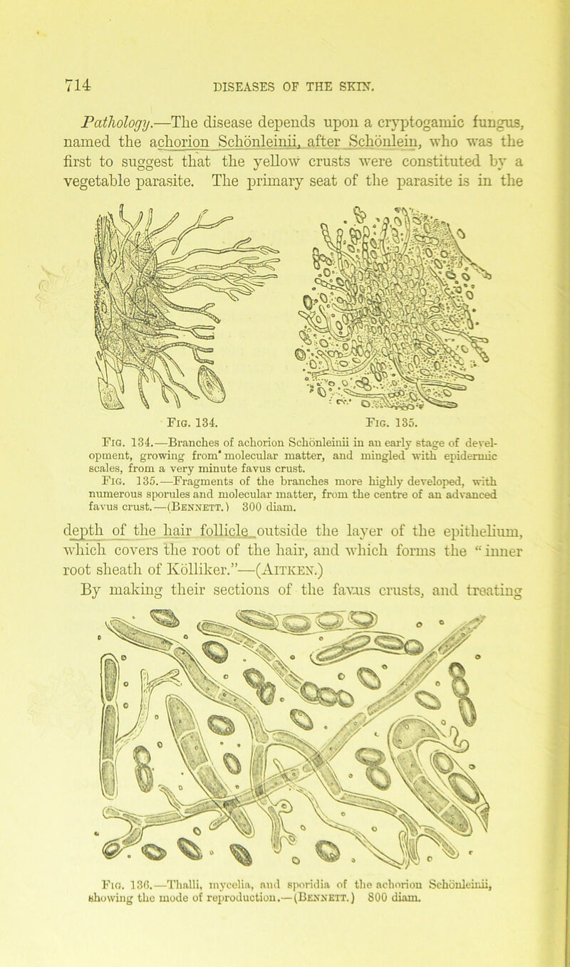 Pathology.—The disease depends upon a cryptogamic fungus, named the achorion Schonleinii, after Schonlein, who was the first to suggest that the yellow crusts were constituted by a vegetable parasite. The primary seat of the parasite ls in the Fig. 134. Fig. 135. Fig. 134.—Branches of achorion Schonleinii in an early stage of devel- opment, growing from molecular matter, and mingled with epidermic scales, from a very minute favus crust. Fig. 135.—Fragments of the branches more highly developed, -with numerous sporules and molecular matter, from the centre of an advanced favus crust.—(Bennett.) 300 diaru. depth of the hair follicle outside the layer of the epithelium, which covers the root of the hair, and which forms the “ inner root sheath of Kolliker.”—(Aitkex.) By making their sections of the favus crusts, and treating Fig. 130.—Thalli, mycelia, and sporidia of the achorion Schonleinii, showing the mode of reproduction.— (Bennett.) 800 diam.