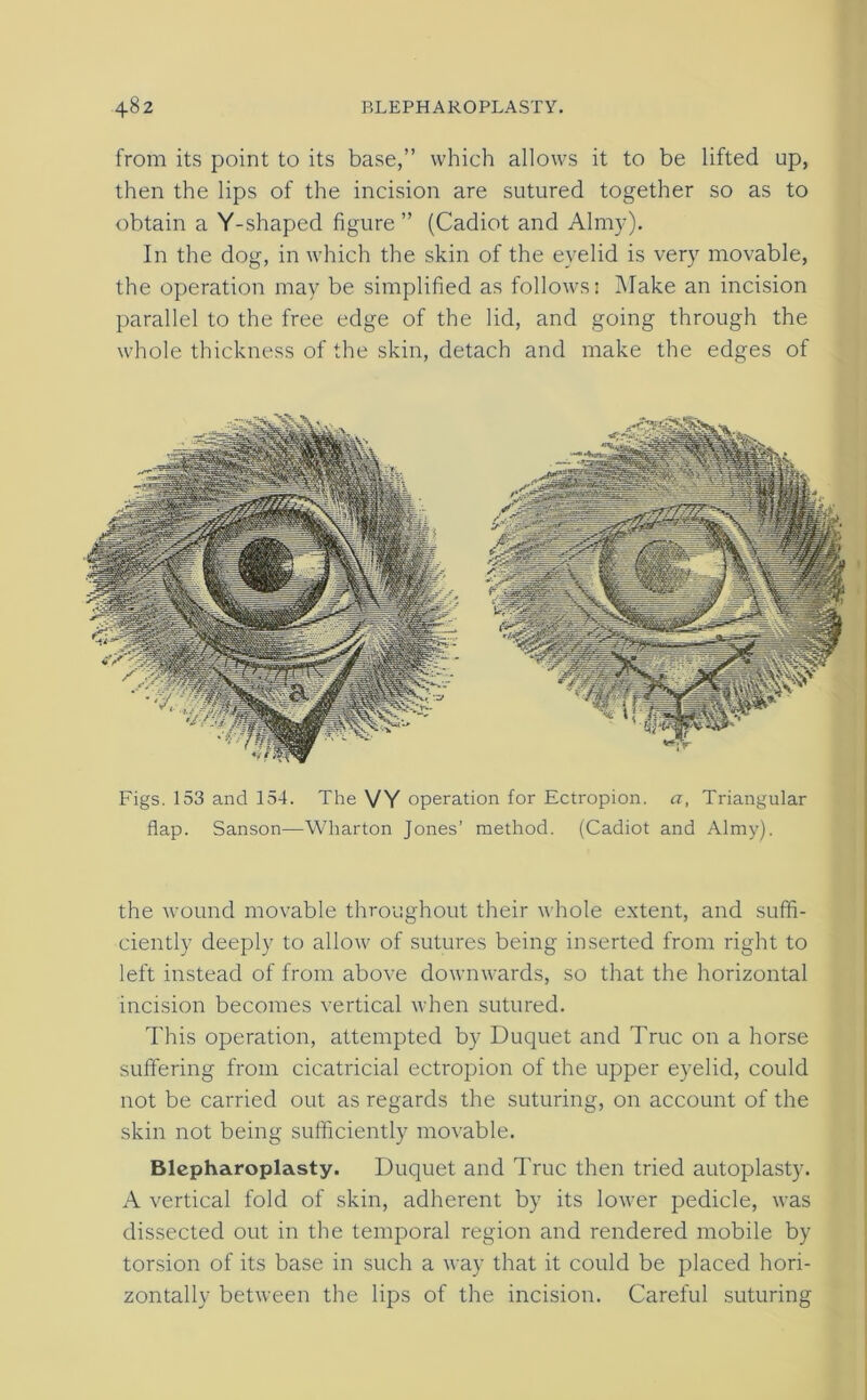 from its point to its base,” which allows it to be lifted up, then the lips of the incision are sutured together so as to obtain a Y-shaped figure ” (Cadiot and Almy). In the dog, in which the skin of the eyelid is very movable, the operation may be simplified as follows: Make an incision parallel to the free edge of the lid, and going through the whole thickness of the skin, detach and make the edges of Figs. 153 and 154. The VY operation for Ectropion, a, Triangular flap. Sanson—Wharton Jones’ method. (Cadiot and Almy). the wound movable throughout their whole extent, and suffi- ciently deeply to allow of sutures being inserted from right to left instead of from above downwards, so that the horizontal incision becomes vertical when sutured. This operation, attempted by Duquet and True on a horse suffering from cicatricial ectropion of the upper eyelid, could not be carried out as regards the suturing, on account of the skin not being sufficiently movable. Blepharoplasty. Duquet and True then tried autoplasty. A vertical fold of skin, adherent by its lower pedicle, was dissected out in the temporal region and rendered mobile by torsion of its base in such a way that it could be placed hori- zontally between the lips of the incision. Careful suturing