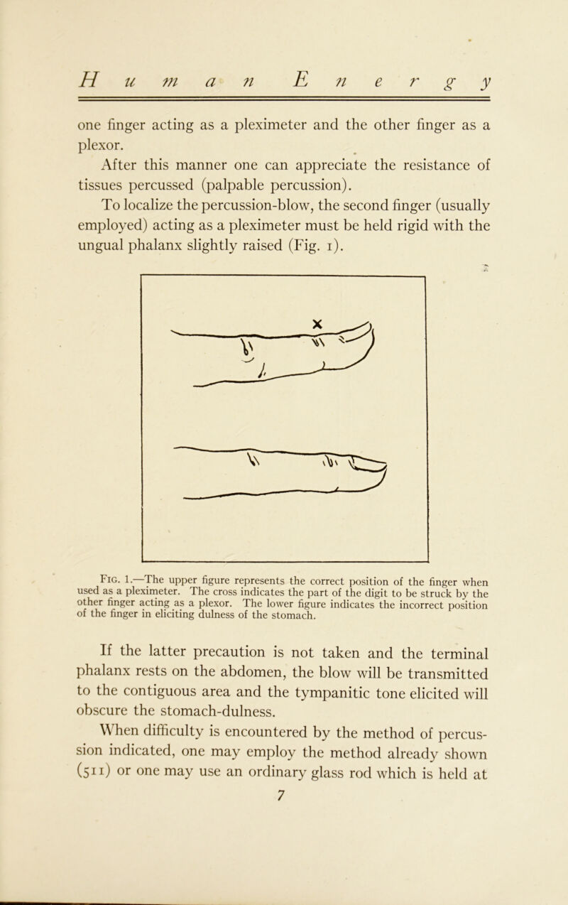 one finger acting as a pleximeter and the other finger as a plexor. After this manner one can appreciate the resistance of tissues percussed (palpable percussion). To localize the percussion-blow, the second finger (usually employed) acting as a pleximeter must be held rigid with the ungual phalanx slightly raised (Fig. i). Fig. 1. The upper figure represents the correct position of the finger when used as a pleximeter. The cross indicates the part of the digit to be struck by the other finger acting as a plexor. The lower figure indicates the incorrect position of the finger in eliciting dulness of the stomach. If the latter precaution is not taken and the terminal phalanx rests on the abdomen, the blow will be transmitted to the contiguous area and the tympanitic tone elicited will obscure the stomach-dulness. When difficulty is encountered by the method of percus- sion indicated, one may employ the method already shown (511) or one may use an ordinary glass rod which is held at